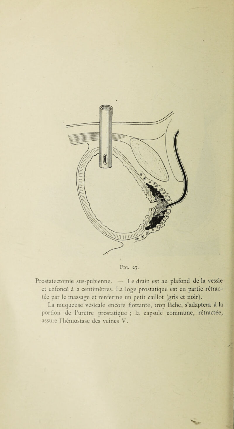 Prostatectomie sus-pubienne. — Le drain est au plafond de la vessie et enfoncé à 2 centimètres. La loge prostatique est en partie rétrac¬ tée par le massage et renferme un petit caillot (gris et noir). La muqueuse vésicale encore flottante, trop lâche, s’adaptera à la portion de l’urètre prostatique ; la capsule commune, rétractée, assure l’hémostase des veines V.