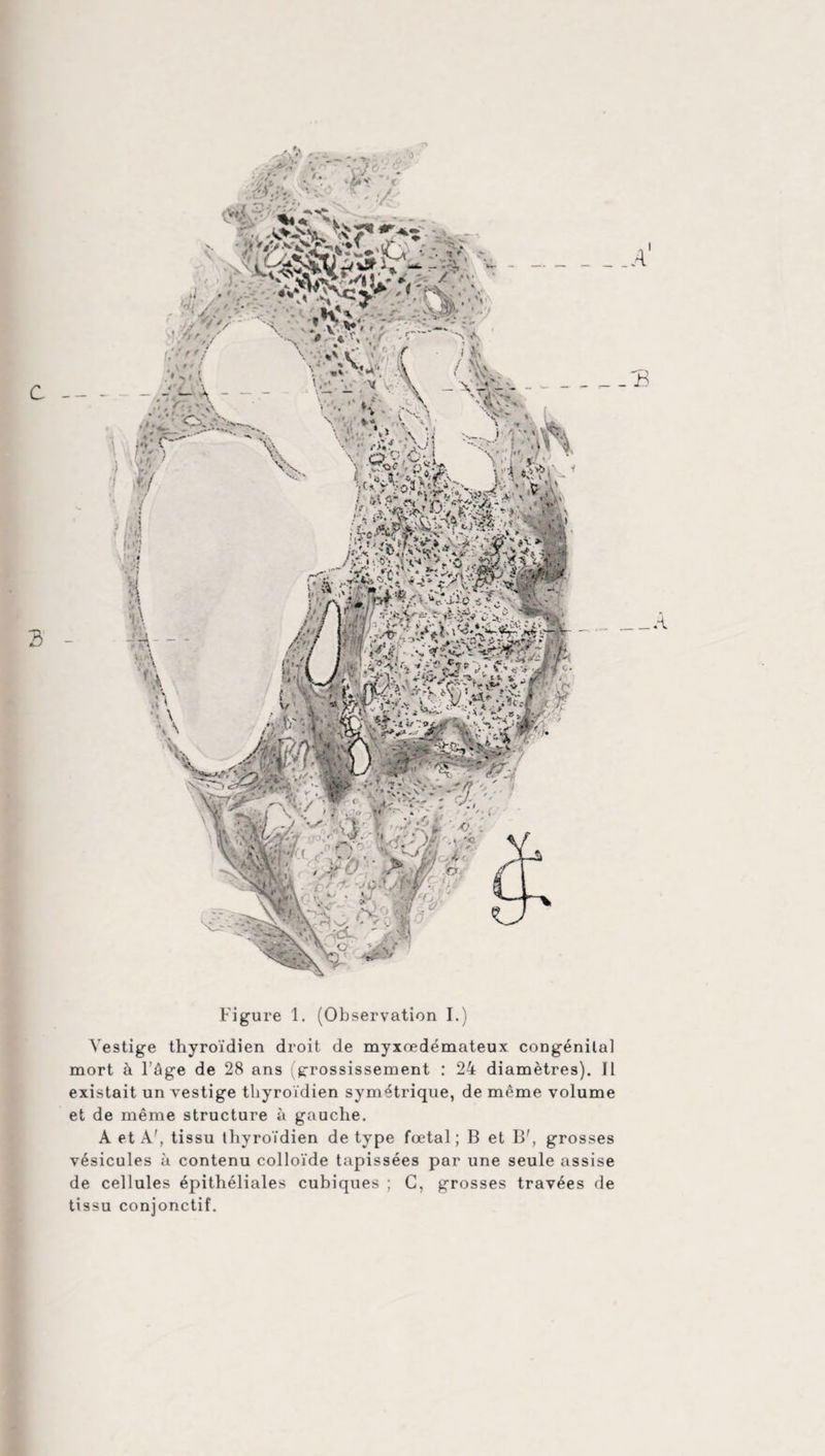 Vestige thyroïdien droit de myxœdémateux congénital mort à l’âge de 28 ans grossissement • 24 diamètres). Il existait un vestige thyroïdien symétrique, de même volume et de même structure à gauche. A et A', tissu thyroïdien de type foetal; B et B', grosses vésicules à contenu colloïde tapissées par une seule assise de cellules épithéliales cubiques ; C, grosses travées de tissu conjonctif.