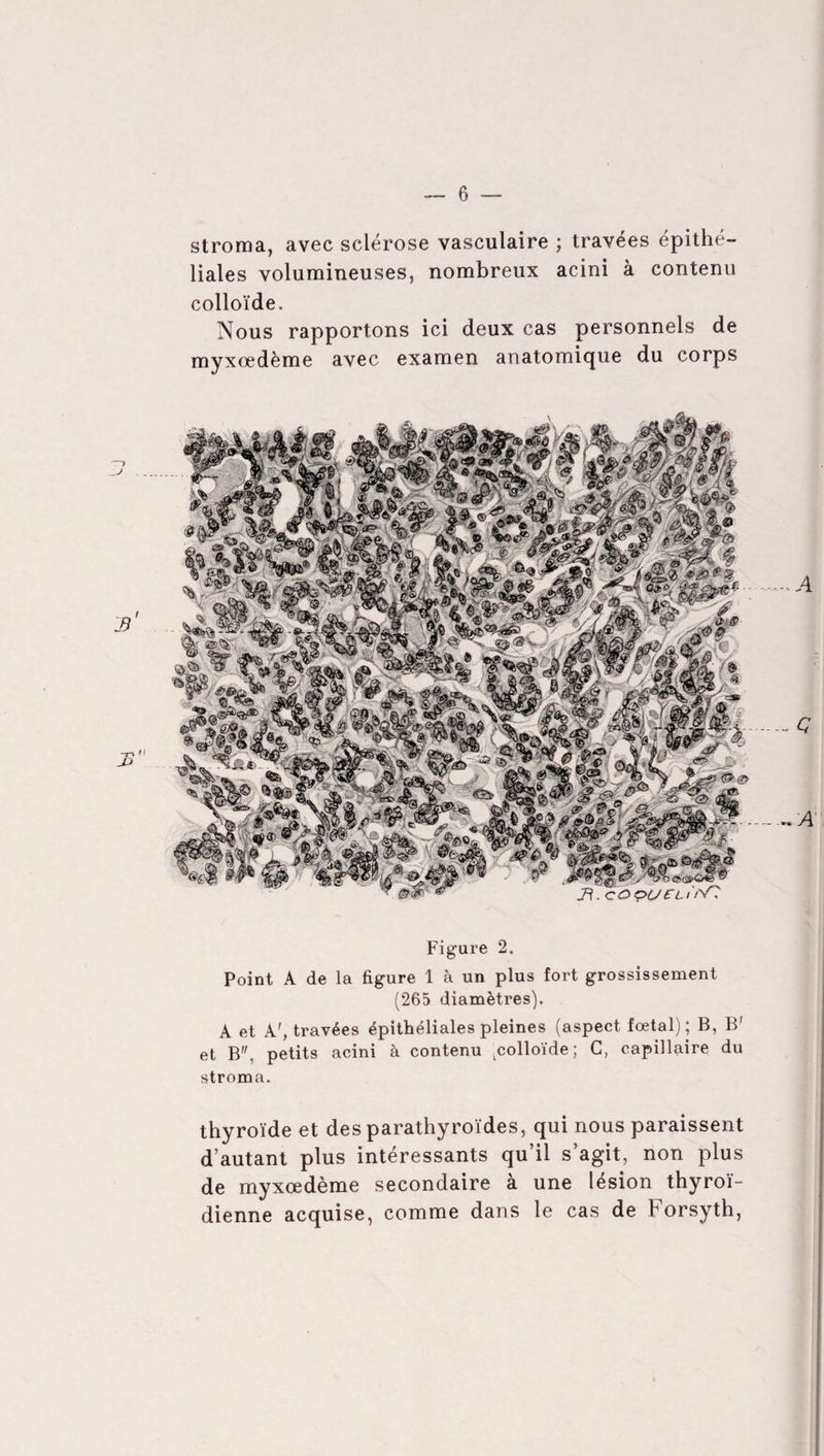 stroma, avec sclérose vasculaire ; travées épithé¬ liales volumineuses, nombreux acini à contenu colloïde. Nous rapportons ici deux cas personnels de myxœdème avec examen anatomique du corps Figure 2. Point A de la figure 1 à un plus fort grossissement (265 diamètres). A et A', travées épithéliales pleines (aspect fœtal); B, B' et B, petits acini à contenu ^colloïde ; C, capillaire du stroma. thyroïde et des parathyroïdes, qui nous paraissent d’autant plus intéressants qu’il s’agit, non plus de myxœdème secondaire à une lésion thyroï¬ dienne acquise, comme dans le cas de Forsyth,