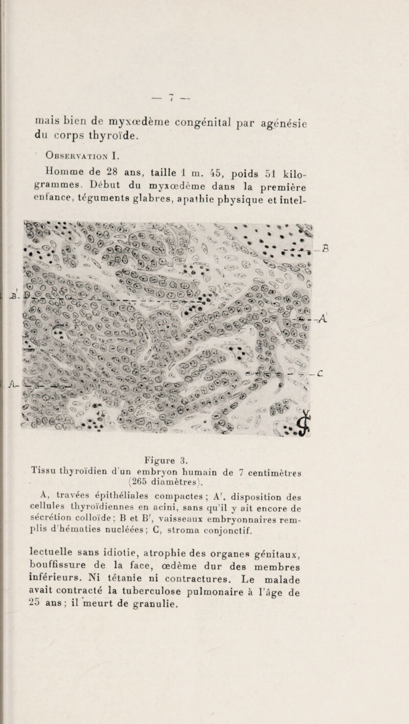 i mais bien de myxœdème congénital par agénésie du corps thyroïde. Observation I. Homme de 28 ans, taille 1 m. 45, poids 51 kilo¬ grammes. Début du myxœdème dans la première enfance, téguments glabres, apathie physique et intel- Figure 3. Tissu thyroïdien d'un embryon humain de 7 centimètres (265 diamètres). A, travées épithéliales compactes ; A', disposition des cellules thyroïdiennes en acini, sans qu’il y ait encore de sécrétion colloïde; B et Bf, vaisseaux embryonnaires rem¬ plis d hématies nucléées; G, stroma conjonctif. lectuelle sans idiotie, atrophie des organes génitaux, bouffissure de la face, œdème dur des membres inférieurs. Ni tétanie ni contractures. Le malade avait contracté la tuberculose pulmonaire à l’âge de 25 ans; il meurt de granulie.