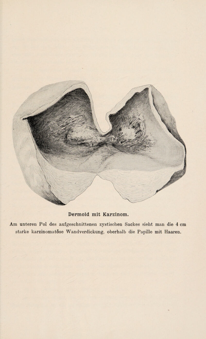 Dermoid mit Karzinom. Am unteren Pol des aufgeschnittenen zystischen Sackes sieht man die 4 cm starke karzinomatöse Wandverdickung, oberhalb die Papille mit Haaren.