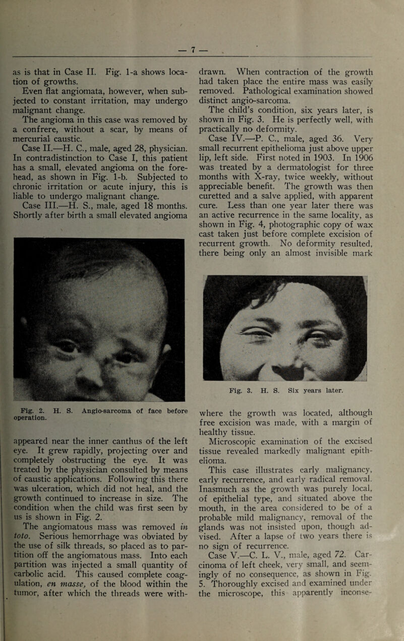 as is that in Case II. Fig. 1-a shows loca¬ tion of growths. Even flat angiomata, however, when sub¬ jected to constant irritation, may undergo malignant change. The angioma in this case was removed by a confrere, without a scar, by means of mercurial caustic. Case II.—H. C., male, aged 28, physician. In contradistinction to Case I, this patient has a small, elevated angioma on the fore¬ head, as shown in Fig. 1-b. Subjected to chronic irritation or acute injury, this is liable to undergo malignant change. Case III.—H. S., male, aged 18 months. Shortly after birth a small elevated angioma drawn. When contraction of the growth had taken place the entire mass was easily removed. Pathological examination showed distinct angio-sarcoma. The child’s condition, six years later, is shown in Fig. 3. He is perfectly well, with practically no deformity. Case IV.—P. C., male, aged 36. Very small recurrent epithelioma just above upper lip, left side. First noted in 1903. In 1906 was treated by a dermatologist for three months with X-ray, twice weekly, without appreciable benefit. The growth was then curetted and a salve applied, with apparent cure. Less than one year later there was an active recurrence in the same locality, as shown in Fig. 4, photographic copy of wax cast taken just before complete excision of recurrent growth. No deformity resulted, there being only an almost invisible mark Fig. 3. H. S. Six years later. Fig. 2. H. S. Angio-sarcoma of face before operation. appeared near the inner canthus of the left eye. It grew rapidly, projecting over and completely obstructing the eye. It was treated by the physician consulted by means of caustic applications. Following this there was ulceration, which did not heal, and the growth continued to increase in size. The condition when the child was first seen by us is shown in Fig. 2. The angiomatous mass was removed in toto. Serious hemorrhage was obviated by the use of silk threads, so placed as to par¬ tition off the angiomatous mass. Into each partition was injected a small quantity of carbolic acid. This caused complete coag¬ ulation, en masse, of the blood within the tumor, after which the threads were with¬ where the growth was located, although free excision was made, with a margin of healthy tissue. Microscopic examination of the excised tissue revealed markedly malignant epith¬ elioma. This case illustrates early malignancy, early recurrence, and early radical removal. Inasmuch as the growth was purely local, of epithelial type, and situated above the mouth, in the area considered to be of a probable mild malignancy, removal of the glands was not insisted upon, though ad¬ vised. After a lapse of two years there is no sign of recurrence. Case V.—C. L. V., male, aged 72. Car¬ cinoma of left cheek, very small, and seem¬ ingly of no consequence, as shown in Fig. 5. Thoroughly excised and examined under the microscope, this apparently inconse-