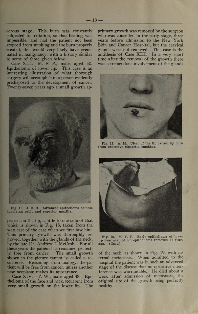 cerous stage. This, burn was constantly subjected to irritation, so that healing was impossible, and had the patient not been stopped from smoking and the burn properly treated, this would very likely have event¬ uated in malignancy, with a history similar to some of those given below. Case XIII.—M. F. P., male, aged 50. Epithelioma of lower lip. This case is an interesting illustration of what thorough surgery will accomplish in a person evidently predisposed to the development of cancer. Twenty-seven years ago a small growth ap- Fig. 16. J. S. R. Advanced epithelioma of nose involving orbit and superior maxilla. peared on the lip, a little to one side of that which is shown in Fig. 18, taken from the wax cast of the case when we first saw him. This primary growth was thoroughly re¬ moved, together with the glands of the neck, by the late Dr. Andrew J. McCosh. For all these years the patient has remained perfect¬ ly free from cancer. The small growth shown in the picture cannot be called a re¬ currence. Reasoning from analogy, the pa¬ tient will be free from cancer, unless another new neoplasm makes its appearance. Case XIV.—T. W., male, aged 48. Epi¬ thelioma of the face and neck, recurrent from very small growth on the lower lip. The primary growth was removed by the surgeon who was consulted in the early stage, three years before admission to the New York Skin and Cancer Hospital, but the cervical glands were not removed. This case is the antithesis of Case XIII. In a very short time after the removal of the growth there was a tremendous involvement of the glands Fig. 17. A. M. Ulcer of the lip caused by burn from excessive cigarette smoking. Fig. 18. M. F. P. Early epithelioma of lower lip near scar of old epithelioma removed 27 years ago. (Cast.) of the neck, as shown in Fig. 19, with in¬ ternal metastasis. When admitted to the hospital the patient was in such an advanced stage of the disease that no operative inter¬ ference was warrantable. He died about a week after admission of metastasis, the original site of the growth being perfectly healthy.