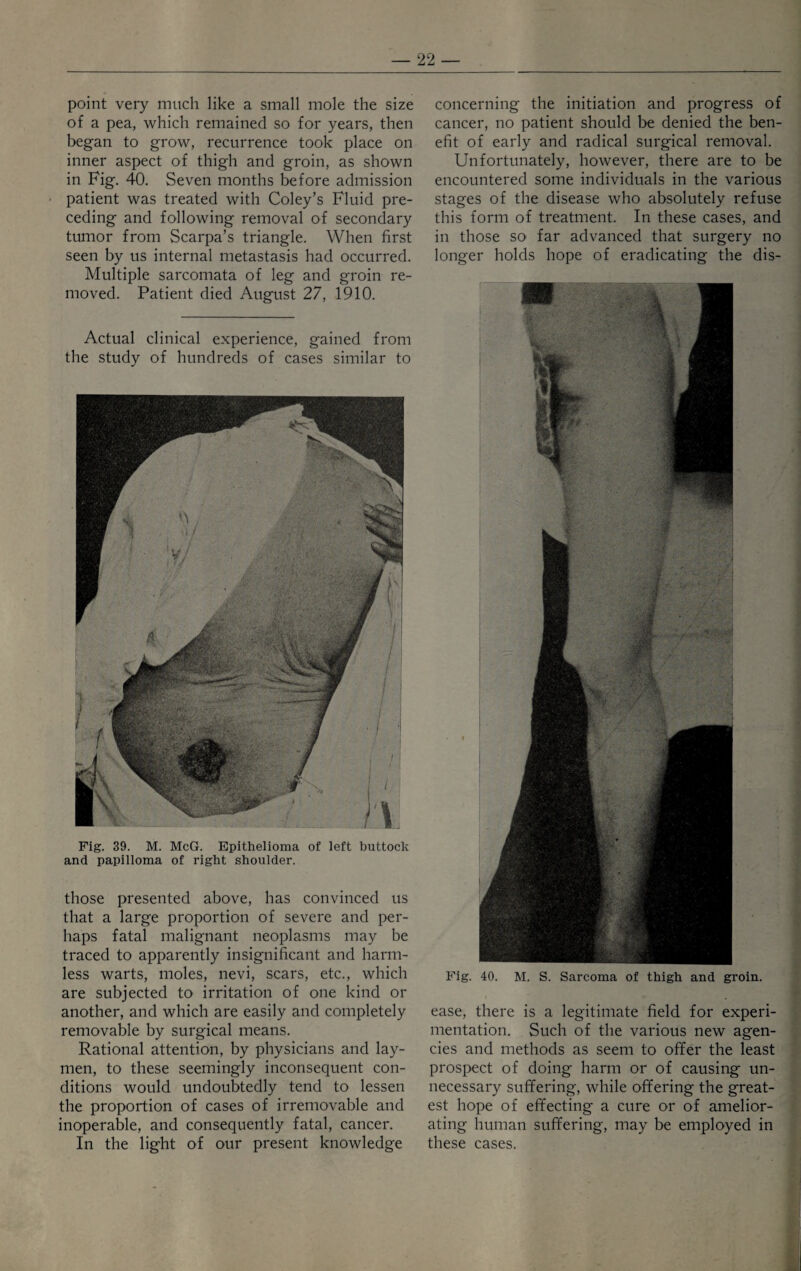 point very much like a small mole the size of a pea, which remained so for years, then began to grow, recurrence took place on inner aspect of thigh and groin, as shown in Fig. 40. Seven months before admission patient was treated with Coley’s Fluid pre¬ ceding and following removal of secondary tumor from Scarpa’s triangle. When first seen by us internal metastasis had occurred. Multiple sarcomata of leg and groin re¬ moved. Patient died August 27, 1910. Actual clinical experience, gained from the study of hundreds of cases similar to Fig. 39. M. McG. Epithelioma of left buttock and papilloma of right shoulder. those presented above, has convinced us that a large proportion of severe and per¬ haps fatal malignant neoplasms may be traced to apparently insignificant and harm¬ less warts, moles, nevi, scars, etc., which are subjected to irritation of one kind or another, and which are easily and completely removable by surgical means. Rational attention, by physicians and lay¬ men, to these seemingly inconsequent con¬ ditions would undoubtedly tend to lessen the proportion of cases of irremovable and inoperable, and consequently fatal, cancer. In the light of our present knowledge concerning the initiation and progress of cancer, no patient should be denied the ben¬ efit of early and radical surgical removal. Unfortunately, however, there are to be encountered some individuals in the various stages of the disease who absolutely refuse this form of treatment. In these cases, and in those so far advanced that surgery no longer holds hope of eradicating the dis- Fig. 40. M. S. Sarcoma of thigh and groin. ease, there is a legitimate field for experi¬ mentation. Such of the various new agen¬ cies and methods as seem to offer the least prospect of doing harm or of causing un¬ necessary suffering, while offering the great¬ est hope of effecting a cure or of amelior¬ ating human suffering, may be employed in these cases.