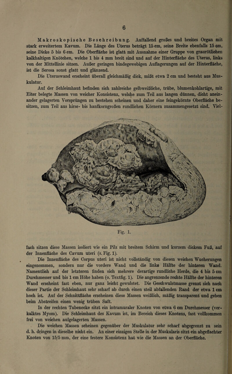 Makroskopische Beschreibung. Auffallend großes und breites Organ mit stark erweitertem Kavum. Die Länge des Uterus beträgt 15 cm, seine Breite ebenfalls 15 cm, seine Dicke 5 bis 6 cm. Die Oberfläche ist glatt mit Ausnahme einer Gruppe von graurötlichen kalkhaltigen Knötchen, welche 1 bis 4 mm breit sind und auf der Hinterfläche des Uterus, links von der Mittellinie sitzen. Außer geringen bindegewebigen Auflagerungen auf der Hinterfläche, ist die Serosa sonst glatt und glänzend. Die Uteruswand erscheint überall gleichmäßig dick, mißt etwa 2 cm und besteht aus Mus¬ kulatur. Auf der Schleimhaut befinden sich zahlreiche gelbweißliche, trübe, blumenkohlartige, mit Eiter belegte Massen von weicher Konsistenz, welche zum Teil aus langen dünnen, dicht anein¬ ander gelagerten Vorsprüngen zu bestehen Schemen und daher eine feingekörnte Oberfläche be¬ sitzen, zum Teil aus hirse- bis hanfkorngroßen rundlichen Körnern zusammengesetzt sind. Viel- Fig. 1. fach sitzen diese Massen isoliert wie ein Pilz mit breitem Schirm und kurzem dickem Fuß, auf der Innenfläche des Cavum uteri (s. Fig. 1). Die Innenfläche des Corpus uteri ist nicht vollständig von diesen weichen Wucherungen eingenommen, sondern nur die vordere Wand und die linke Hälfte der hinteren Wand. Namentlich auf der letzteren finden sich mehrere derartige rundliche Herde, die 4 bis 5 cm Durchmesser und bis 1 cm Höhe haben (o. Textfig. 1). Die angrenzende rechte Hälfte der hinteren Wand erscheint fast eben, nur ganz leicht gewulstet. Die Geschwulstmasse grenzt sich nach dieser Partie der Schleimhaut sehr scharf ab durch einen steil abfallenden Rand der etwa 1 cm hoch ist. Auf der Schnittfläche erscheinen diese Massen weißlich, mäßig transparent und geben beim Abstreifen einen wenig trüben Saft. In der rechten Tubenecke sitzt ein intramuraler Knoten von etwa 6 cm Durchmesser (ver¬ kalktes Myom). Die Schleimhaut des Kavum ist, im Bereich dieses Knotens, fast vollkommen frei von weichen aufgelagerten Massen. Die weichen Massen scheinen gegenüber der Muskulatur sehr scharf abgegrenzt zu sein d. h. dringen in dieselbe nicht ein. An einer einzigen Stelle in der Muskularis sitzt ein abgeflachter Knoten von 15/5 mm, der eine festere Konsistenz hat wie die Massen an der Oberfläche.