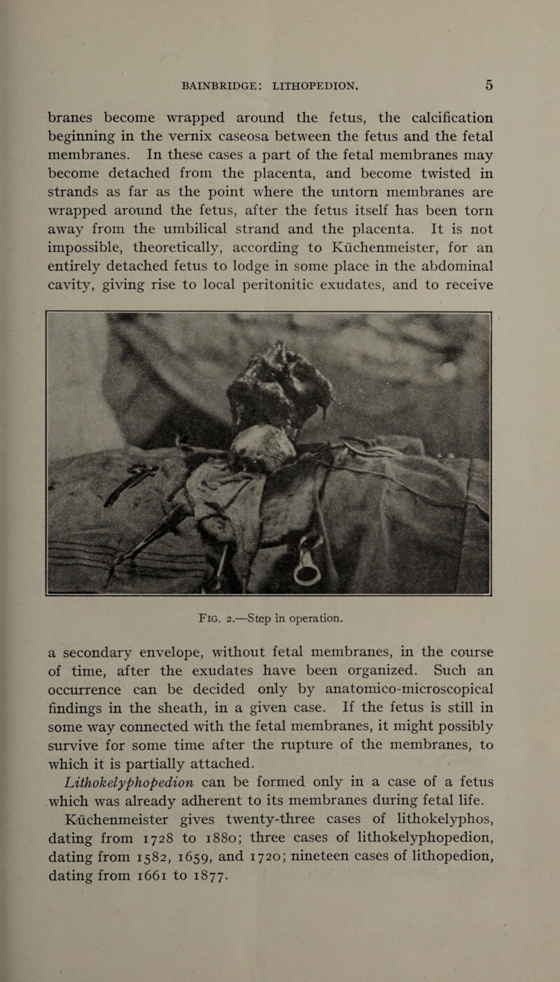 branes become wrapped around the fetus, the calcification beginning in the vernix caseosa between the fetus and the fetal membranes. In these cases a part of the fetal membranes may become detached from the placenta, and become twisted in strands as far as the point where the untorn membranes are wrapped around the fetus, after the fetus itself has been torn away from the umbilical strand and the placenta. It is not impossible, theoretically, according to Kuchenmeister, for an entirely detached fetus to lodge in some place in the abdominal cavity, giving rise to local peritonitic exudates, and to receive Fig. 2.—Step in operation. a secondary envelope, without fetal membranes, in the course of time, after the exudates have been organized. Such an occurrence can be decided only by anatomico-microscopical findings in the sheath, in a given case. If the fetus is still in some way connected with the fetal membranes, it might possibly survive for some time after the rupture of the membranes, to which it is partially attached. Lithokelyphopedion can be formed only in a case of a fetus which was already adherent to its membranes during fetal life. Kuchenmeister gives twenty-three cases of lithokelyphos, dating from 1728 to 1880; three cases of lithokelyphopedion, dating from 1582, 1659, and 1720; nineteen cases of lithopedion, dating from 1661 to 1877.