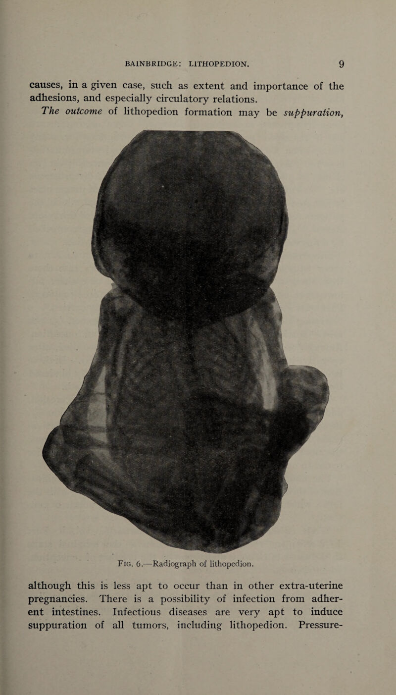 causes, in a given case, such as extent and importance of the adhesions, and especially circulatory relations. The outcome of lithopedion formation may be suppuration, Fig. 6.—Radiograph of lithopedion. although this is less apt to occur than in other extra-uterine pregnancies. There is a possibility of infection from adher¬ ent intestines. Infectious diseases are very apt to induce suppuration of all tumors, including lithopedion. Pressure-