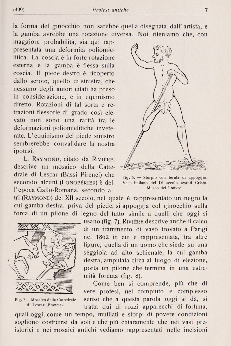 la forma del ginocchio non sarebbe quella disegnata dalP artista, e la gamba avrebbe una rotazione diversa. Noi riteniamo che, con maggiore probabilité, sia qui rap- presentata una deformità poliomie- litica. La coscia è in forte rotazione esterna e la gamba è flessa sulla coscia. Il piede destro è ricoperto dallo scroto, quello di sinistra, che nessuno degli autori citati ha preso in considerazione, è in equinismo diretto. Rotazioni di tal sorta e re trazioni flessorie di grado cosi ele- vato non sono una rarità fra le deformazioni poliomielitiche invete¬ rate. L’ equinismo del piede sinistro sembrerebbe convalidare la nostra ipotesi. L. Raymond, citato da Rivière, descrive un mosaico della Catte- drale di Lescar (Bassi Pirenei) che secondo alcuni (Longpérier) è del- P epoca Gallo-Romana, secondo al- tri (Raymond) del XII secolo, nel quale è rappresentato un negro la cui gamba destra, priva del piede, si appoggia col ginocchio sulla força di un pilone di legno del tutto simile a quelli che oggi si usano (fig. 7). Rivière descrive anche il calco di un frammento di vaso trovato a Parigi nel 1862 in cui è rappresentata, tra altre figure, quella di un uomo che siede su una seggiola ad alto schienale, la cui gamba destra, amputata circa al luogo di elezione, porta un pilone che termina in una estre- mità forcuta (fig. 8). Come ben si comprende, più che di vere protesi, nel compiuto e complesso senso che a questa parola oggi si dà, si tratta qui di rozzi apparecchi di fortuna, quali oggi, come un tempo, mutilati e storpi di povere condizioni sogliono costruirsi da soli e che più chiaramente che nei vasi pre- istorici e nei mosaici antichi vediamo rappresentati nelle incisioni Fig. 6. — Storpio con ferula di appoggio. Vaso italiano del IV secolo avanti Cristo. Museo del Louvre. Fig. 7 — Mosaico della Cattedrale di Lescar (Francia).