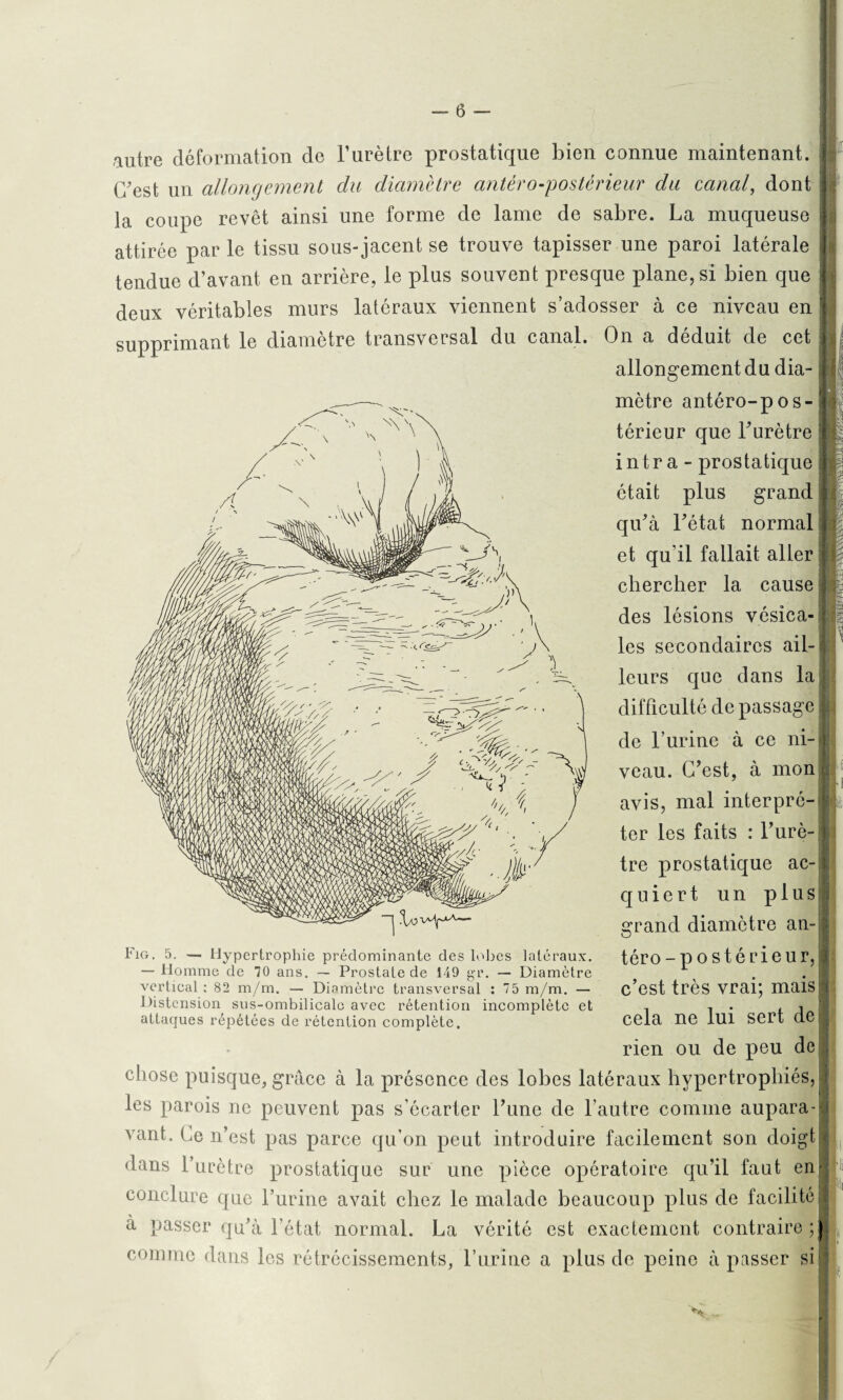 autre déformation de l’urètre prostatique bien connue maintenant. C'est un allongement du diamètre antéro-postérieur du canal, dont la coupe revêt ainsi une forme de lame de sabre. La muqueuse attirée par le tissu sous-jacent se trouve tapisser une paroi latérale tendue d’avant en arrière, le plus souvent presque plane, si bien que deux véritables murs latéraux viennent s’adosser à ce niveau en supprimant le diamètre transversal du canal. On a déduit de cet allongement du dia¬ mètre antéro-pos¬ térieur que l'urètre intra - prostatique était plus grand qu'à l'état normal et qu’il fallait aller chercher la cause des lésions vésica¬ les secondaires ail¬ leurs que dans la difficulté de passage de l’urine à ce ni¬ veau. C'est, à mon avis, mal interpré¬ ter les faits : l'urè¬ tre prostatique ac¬ quiert un plus grand diamètre an- téro-postérieur,! c’est très vrai; mais} cela ne lui sert de rien ou de peu de chose puisque, grâce à la présence des lobes latéraux hypertrophiés, les parois ne peuvent pas s’écarter l'une de l’autre comme aupara¬ vant. Ce n’est pas parce qu’on peut introduire facilement son doigt dans l’urètre prostatique sur une pièce opératoire qu’il faut en conclure que l’urine avait chez le malade beaucoup plus de facilité a passer qu'à l’état normal. La vérité est exactement contraire;; comme dans les rétrécissements, Lurine a plus de peine à passer si Fig. 5. — Hypertrophie prédominante des lobes latéraux. — Homme de 70 ans. — Prostate de 149 gr. — Diamètre vertical: 82 m/m. — Diamètre transversal : 75 m/m. — Distension sus-ombilicale avec rétention incomplète et attaques répétées de rétention complète.