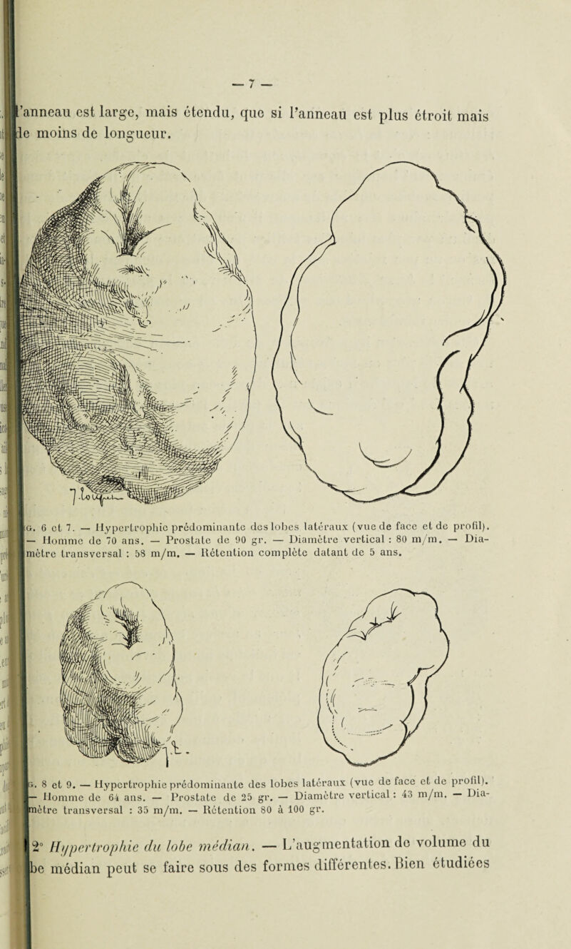 'anneau est large, mais étendu, que si l’anneau est plus étroit mais le moins de longueur. o. 6 et 7. — Hypertrophie prédominante des lobes latéraux (vue de face et de profil). — Homme de 70 ans. — Prostate de 90 gr. — Diamètre vertical : 80 m/m. — Dia¬ mètre transversal : b8 m/m. — Rétention complète datant de 5 ans. la. 8 et 9. — Hypertrophie prédominante des lobes latéraux (vue de face et de profil). ! — Homme de 64 ans. — Prostate de 25 gr. — Diamètre vertical : 4.o m/m. I ha- |mètre transversal : 35 m/m. — Rétention 80 à 100 gr. 2° Hypertrophie du lobe médian. — L’augmentation de volume du jbe médian peut se faire sous des formes différentes. Bien étudiées