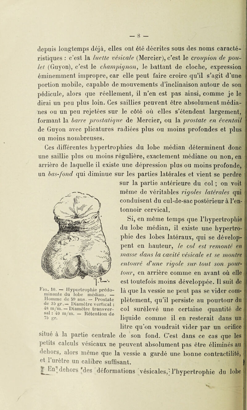 depuis longtemps déjà, elles ont été décrites sous des noms caracté¬ ristiques : c’est la luette vésicale (Mercier), c’est le croupion de pou¬ let (Guyon), c’est le champignon, te battant de cloche, expression éminemment impropre, car elle peut faire croire qu’il s’agit d’une portion mobile, capable de mouvements d’inclinaison autour de son pédicule, alors que réellement, il n’en est pas ainsi, comme je le dirai un peu plus loin. Ces saillies peuvent être absolument média¬ nes ou un peu rejetées sur le côté où elles s’étendent largement, formant la havre prostatique de Mercier, ou la prostate en éventail de Guyon avec plicatures radiées plus ou moins profondes et plus ou moins nombreuses. Ces différentes hypertrophies du lobe médian déterminent donc une saillie plus ou moins régulière, exactement médiane ou non, en arrière de laquelle il existe une dépression plus ou moins profonde, un bas-fond qui diminue sur les parties latérales et vient se perdre sur la partie antérieure du col ; on voit même de véritables rigoles latérales qui conduisent du cul-de-sac postérieur à l’en¬ tonnoir cervical. Si, en même temps que l’hypertrophie ! du lobe médian, il existe une hypertro¬ phie des lobes latéraux, qui se dévelop¬ pent en hauteur, le col est remonté en \ masse dans la cavité vésicale et se montre . entouré d'une rigole sur tout son pour¬ tour, en arrière comme en avant où elle j est toutefois moins développée. Il suit de | là que la vessie ne peut pas se vider com¬ plètement, qu’il persiste au pourtour du col surélevé une certaine quantité de liquide comme il en resterait dans un litre qu’on voudrait vider par un orifice situé à la partie centrale de son fond. C’est dans ce cas que les petits calculs vésicaux ne peuvent absolument pas être éliminés ail j dehors, alors même que la vessie a gardé une bonne contractilité, et 1 urètre un calibre suffisant. ' 'fi I Homme de 59 ans. — Prostate de 35 gr.— Diamètre vertical : 48 m/m. — Diamètre transver¬ sal : 40 m/m. — Rétention de 75 gr. dehors des déformations vésicales,l’hypertrophie du lobe