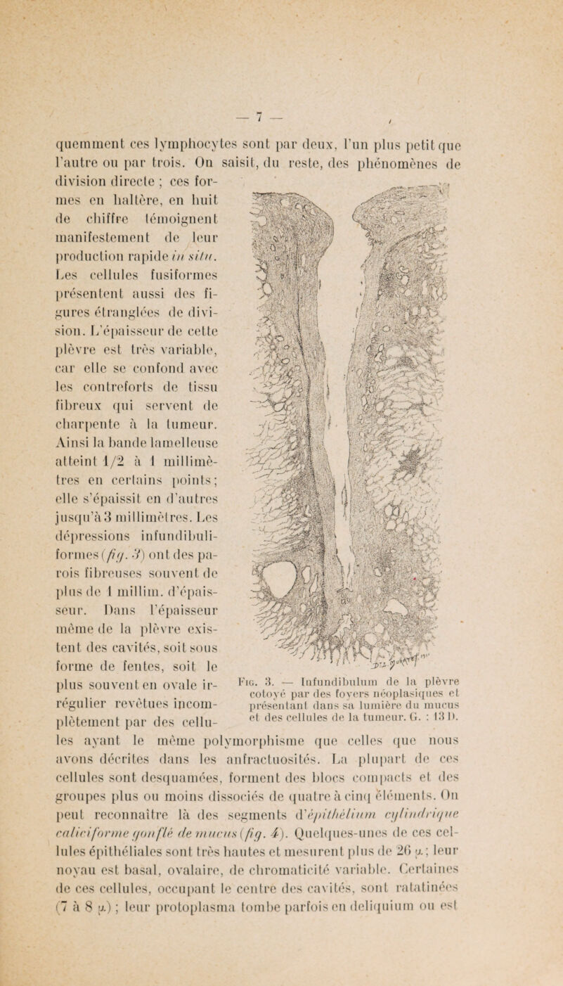 quemment ces lymphocytes sont par deux, l’un plus petit que l’autre ou par trois. On saisit, du reste, des phénomènes de division directe ; ces for¬ mes en haltère, en huit de chiffre témoignent manifestement de leur production rapide/// situ. Les cellules fusiformes présentent aussi des fi¬ gures étranglées de divi¬ sion. L'épaisseur de celte plèvre est très variable, car elle se confond avec les contreforts de tissu fibreux qui servent de charpente à la tumeur. Ainsi la bande lamelleuse atteint 1/2 à 1 millimè¬ tres en certains points; elle s’épaissit en d’autres jusqu’à3 millimètres. Les dépressions infundibuli- formes (/?//. S) ont des pa¬ rois fibreuses souvent de plus de 1 millim. d’épais¬ seur. Dans l’épaisseur même de la plèvre exis¬ tent des cavités, soit sous forme de fentes, soit le ])lus souvent en ovale ir- Fig* 3. — Itifundibulum de la plèvre cotoyé par des foyers néoplasiques et régulier revêtues incom- présentant dans sa lumière du mucus plètement par des cellu- et des cellules de la tumeur. G. . Idl>. les ayant le même polymorphisme que celles que nous avons décrites dans les anfractuosités. La plupart de ces cellules sont desquamées, forment des blocs compacts et des groupes plus ou moins dissociés de quatre à cinq éléments. On peut reconnaître là des segments d’épithélium cyliudri</ue caliciforme f/ou fié de mucus (fi y. 4). Quelques-unes de ces cel¬ lules épithéliales sont très hautes et mesurent plus de 26 u.; leur noyau est basal, ovalaire, de chromaticité variable. Certaines de ces cellules, occupant le centre des cavités, sont ratatinées