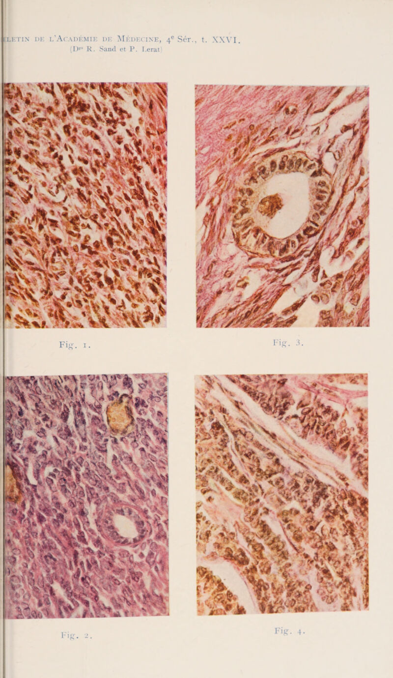 LKTIN DK l’AcADÏ'.MIE DK MÉDECINE, 4e Sér., t. XXVI. I )r R. Sand et P. I .erat Fig. i. Fig-. 3. I Fig. 4*