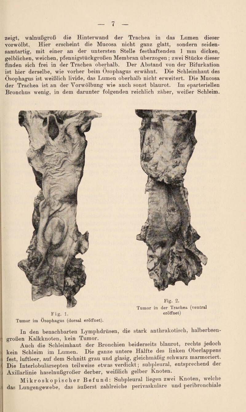 zeigt, walnußgroß die Hinterwand der Trachea in das Lumen dieser vorwölbt. Hier erscheint die Mucosa nicht ganz glatt, sondern seiden¬ samtartig, mit einer an der untersten Stelle festhaftenden 1 mm dicken, gelblichen, weichen, pfennigstückgroßen Membran überzogen ; zwei Stücke dieser finden sich frei in der Trachea oberhalb. Der Abstand von der Bifurkation ist hier derselbe, wie vorher beim Ösophagus erwähnt. Die Schleimhaut des Ösophagus ist weißlich livide, das Lumen oberhalb nicht erweitert. Die Mucosa der Trachea ist an der Yorwölbung wie auch sonst blaurot. Im eparteriellen Bronchus wenig, in dem darunter folgenden reichlich zäher, weißer Schleim. In den benachbarten Lymphdrüsen, die stark anthrakotisch, halberbsen- 1 großen Kalkknoten, kein Tumor. Auch die Schleimhaut der Bronchien beiderseits blaurot, rechts jedoch * kein Schleim im Lumen. Die ganze untere Hälfte des linken Oberlappens !jj fest, luftleer, auf dem Schnitt grau und glasig, gleichmäßig schwarz marmoriert, ij Die Interlobulärsepten teilweise etwas verdickt; subpleural, entsprechend der ;| Axillarlinie haselnußgroßer derber, weißlich gelber Knoten. Mikroskopischer Befund: Subpleural liegen zwei Knoten, welche das Lungengewebe, das äußerst zahlreiche perivaskuläre und peribronchiale Fig. 1. Tumor im Ösophagus (dorsal eröffnet). Fig. 2. Tumor in der Trachea (ventral eröffnet)