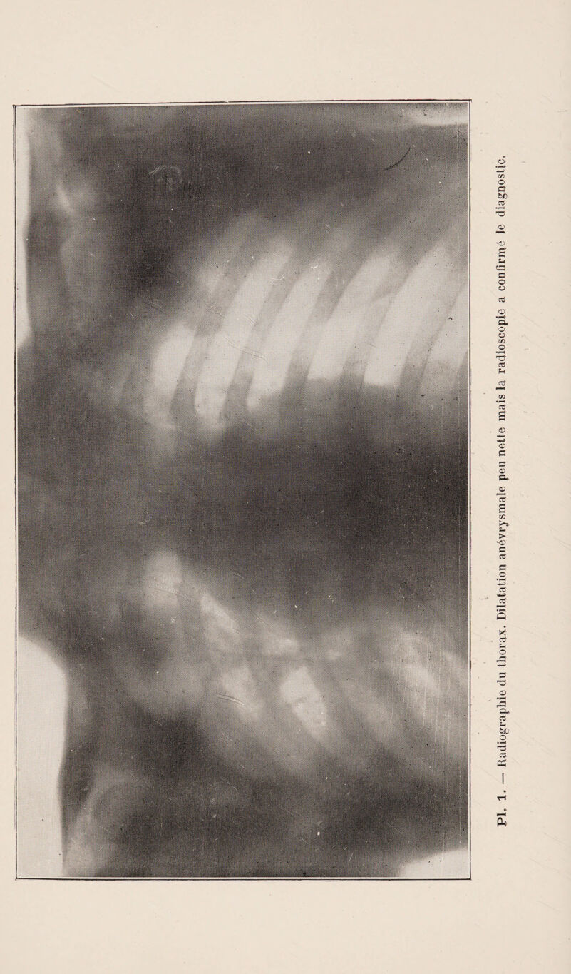 Radiographie du thorax. Dilatation anévrysmale peu nette mais la radioscopie a confirmé le diagnostic,