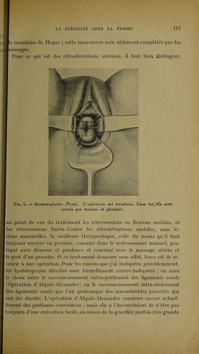 Fig. 5. — Stomatoplastie iPozzi). L’opération est terminée. Tous les fils sont serrés par torsion et plombés. au point de vue du traitement les rétroversions ou flexions mobiles, et les rétroversions fixées. Contre les rétrodéviations mobiles, sans lé¬ sions annexielles, la meilleure thérapeutique, celle du moins qu’il faut toujours essayer en premier, consiste dans le redressement manuel, pra¬ tiqué avec douceur et prudence et combiné avec le massage utérin et | le port d’un pessaire. Si ce traitement demeure sans effet, force est de re¬ courir à une opération. Pour les raisons que j’ai indiquées précédemment, les hystéropexies directes sont formellement contre-indiquées ; on aura le choix entre le raccourcissement extra-péritonéal des ligaments ronds (Opération d’Alquié-Alexander) ou le raccourcissement intra-abdominal des ligaments ronds par l’un quelconque des innombrables procédés qui ont été décrits. L’opération d'Alquié-Alexander conserve encore actuel¬ lement des partisans convaincus ; mais elle a l’inconvénient de n’être pas toujours d’une exécution facile,en raison de la gracilité parfois très grande LA STÉRILITÉ CHEZ LA FEMME 167 forl urJBe mandrins de Hegar ; cette manœuvre sera utilement complétée par des ioijBnassages. Pour ce qui est dns rétrodéviations utérines, il faut bien distinguer,