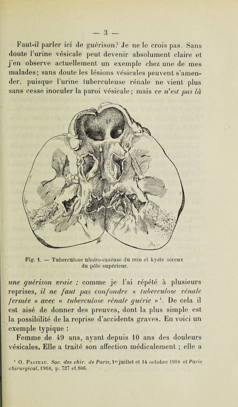 Faut-il parler ici de guérison? Je ne le crois pas. Sans doute l’urine vésicale peut devenir absolument claire et j’en observe actuellement un exemple chez une de mes malades; sans doute les lésions vésicales peuvent s’amen¬ der, puisque burine tuberculeuse rénale ne vient plus sans cesse inoculer la paroi vésicale; mais ce n'est pas là Fig. i. — Tuberculose ulcéro-caséuse du rein et kyste séreux du pôle supérieur. une guérison maie : comme je l’ai répété à plusieurs reprises, il ne faut pas confondre « tuberculose rénale fermée » avec « tuberculose rénale guérie »i. De cela il est aisé de donner des preuves, dont la plus simple est la possibilité de la reprise d’accidents graves. En voici un exemple typique : Femme de 49 ans, ayant depuis 10 ans des douleurs vésicales. Elle a traité son affection médicalement ; elle a i O. Pasteau. Soc. des chir. de Paris, 1evjuillet et 14 octobre 1910 et Paris chirurgical, 1910, p. 727 et 806.