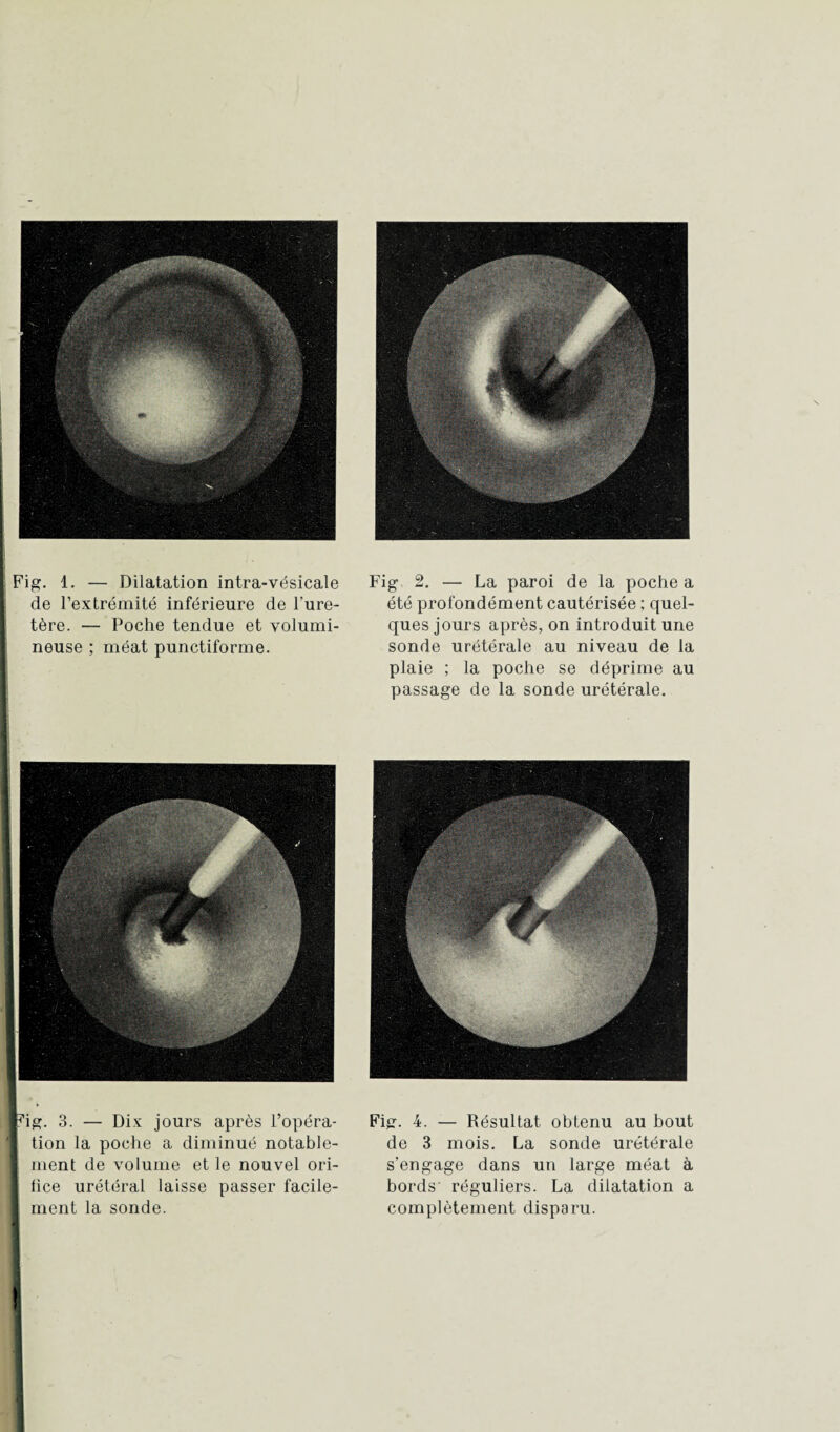 Ide l’extrémité inférieure de l'ure¬ tère. — Poche tendue et volumi- ! neuse ; méat punctiforme. . 3. — Dix jours après l’opéra¬ tion la poche a diminué notable¬ ment de volume et le nouvel ori- lice urétéral laisse passer facile¬ ment la sonde. été profondément cautérisée ; quel¬ ques jours après, on introduit une sonde urétérale au niveau de la plaie ; la poche se déprime au passage de la sonde urétérale. Fig. 4. — Résultat obtenu au bout de 3 mois. La sonde urétérale s'engage dans un large méat à bords réguliers. La dilatation a complètement disparu.