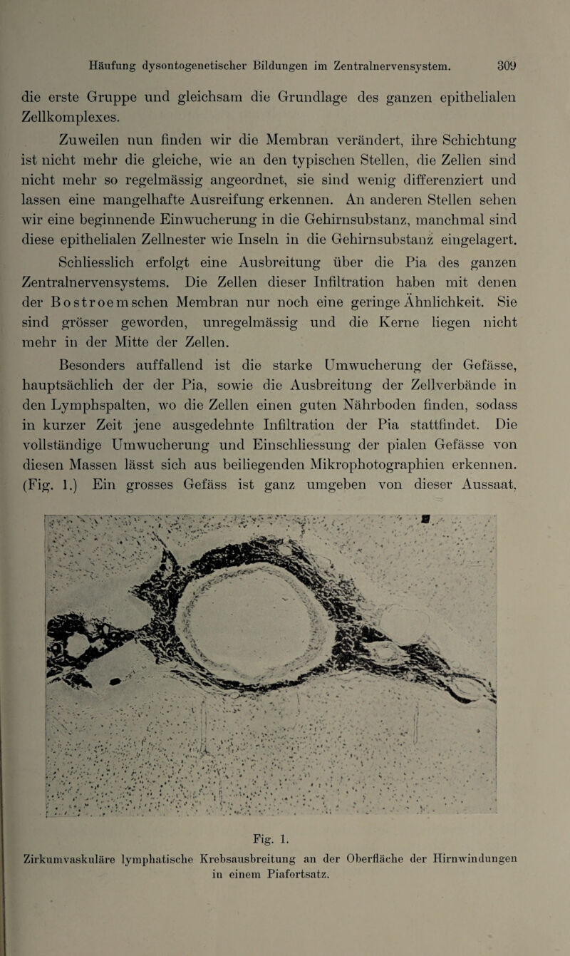 die erste Gruppe und gleichsam die Grundlage des ganzen epithelialen Zellkomplexes. Zuweilen nun finden wir die Membran verändert, ihre Schichtung ist nicht mehr die gleiche, wie an den typischen Stellen, die Zellen sind nicht mehr so regelmässig angeordnet, sie sind wenig differenziert und lassen eine mangelhafte Ausreifung erkennen. An anderen Stellen sehen wir eine beginnende Einwucherung in die Gehirnsubstanz, manchmal sind diese epithelialen Zellnester wie Inseln in die Gehirnsubstanz eingelagert. Schliesslich erfolgt eine Ausbreitung über die Pia des ganzen Zentralnervensystems. Die Zellen dieser Infiltration haben mit denen der B o stroem sehen Membran nur noch eine geringe Ähnlichkeit. Sie sind grösser geworden, unregelmässig und die Kerne liegen nicht mehr in der Mitte der Zellen. Besonders auffallend ist die starke Umwucherung der Gefässe, hauptsächlich der der Pia, sowie die Ausbreitung der Zellverbände in den Lymphspalten, wo die Zellen einen guten Nährboden finden, sodass in kurzer Zeit jene ausgedehnte Infiltration der Pia stattfindet. Die vollständige Umwucherung und Einschliessung der pialen Gefässe von diesen Massen lässt sich aus beiliegenden Mikrophotographien erkennen. (Fig. 1.) Ein grosses Gefäss ist ganz umgeben von dieser Aussaat. Fig. 1. Zirkumvaskuläre lymphatische Krebsausbreitung an der Oberfläche der Hirnwindungen in einem Piafortsatz.