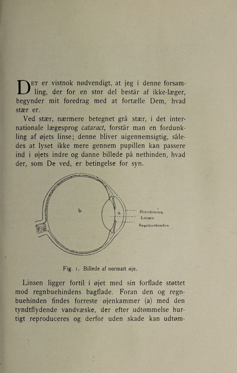 ling, der for en stor del består af ikke-læger, begynder mit foredrag med at fortælle Dem, hvad stær er. Ved stær, nærmere betegnet grå stær, i det inter¬ nationale lægesprog cataract, forstår man en fordunk¬ ling af øjets linse; denne bliver uigennemsigtig, såle¬ des at lyset ikke mere gennem pupillen kan passere ind i øjets indre og danne billede på nethinden, hvad der, som De ved, er betingelse for syn. Hornhinden Linsen Re^nlKi (»hinden Fig. i. Billede af normalt øje. Linsen ligger fortil i øjet med sin forflade støttet mod regnbuehindens bagflade. Foran den og regn¬ buehinden findes forreste øjenkammer (a) med den tyndtflydende vandvæske, der efter udtømmelse hur¬ tigt reproduceres og derfor uden skade kan udtøm-