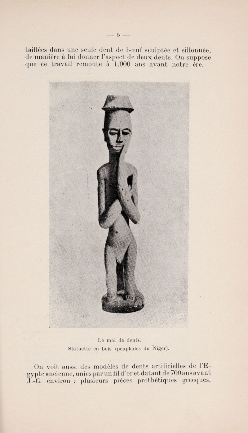 taillees dans une seule dent de boenf sculptee ct sillonnee, de maniere a Ini donner l’aspect de deux dents. On suppose que ce travail remonte a 1.000 ans avant notre ere. Le mal de denis. Statuette en bois (peuplades du Niger). On voit aussi des modeles de dents artificielles de l’E- gypte ancienne, unies par un fil d’or et datant de 700ansavant J.-G. environ ; plusieurs pieces prothetiques grecques,