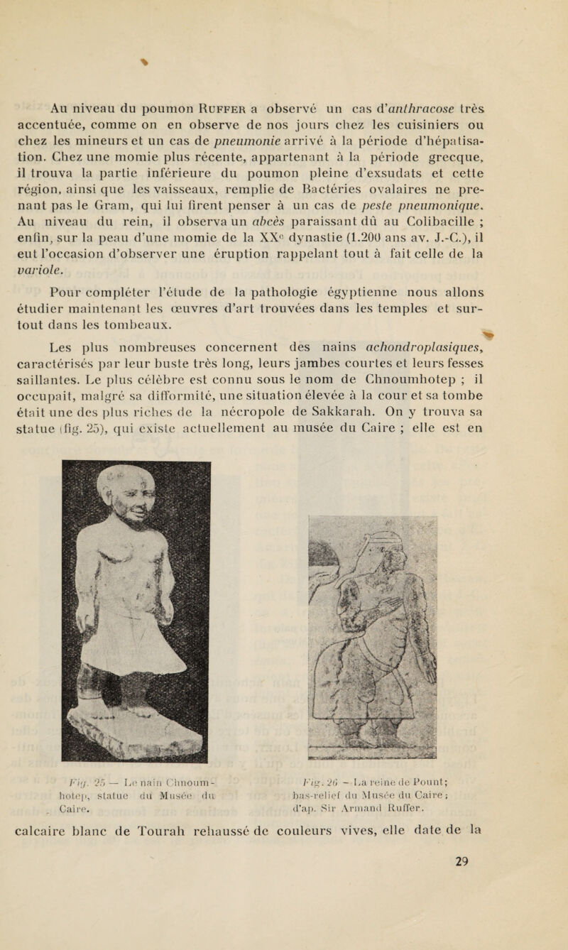 % x\u niveau du poumon Rüffer a observé un cas iVanlhracose très accentuée, comme on en observe de nos jours chez les cuisiniers ou chez les mineurs et un cas de pueumo/i/e arrivé à la période d’hépatisa¬ tion. Chez une momie plus récente, appartenant à la période grecque, il trouva la partie inférieure du poumon pleine d’exsudats et cette région, ainsi que les vaisseaux, remplie de Bactéries ovalaires ne pre¬ nant pas le Gram, qui lui ürent penser à un cas de peste pneumonique. Au niveau du rein, il observa un abcès paraissant dû au Colibacille ; enfin, sur la peau d’une momie de la XX‘' dynastie (1.200 ans av. J.-C.), il eut l’occasion d’observer une éruption rappelant tout à fait celle de la variole. Pour compléter l’étude de la pathologie égyptienne nous allons étudier maintenant les œuvres d’art trouvées dans les temples et sur¬ tout dans les tombeaux. Les plus nombreuses concernent des nains achondroplasiqueSy caractérisés par leur buste très long, leurs jambes courtes et leurs fesses saillantes. Le plus célèbre est connu sous le nom de Chnoumhotep ; il occupait, malgré sa difformité, une situation élevée à la cour et sa tombe était une des plus riches de la nécropole de Sakkarali. On y trouva sa statue (fig. 25), qui existe actuellement au musée du Caire ; elle est en '2r>— liC'naii) (31tnoum- hotep, statue du Musée du Caire. 2i> ~ La reine de Pount; bas-relief du Musée du Caire; d’af). Sir Armand Iluffer. calcaire blanc de Tourah rehaussé de couleurs vives, elle date de la