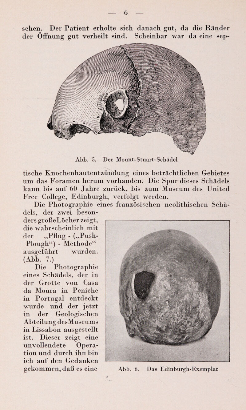 schen. Der Patient erholte sich danach gut, da die Rander der Offnung gut verheilt sind. Scheinbar war da eine sep- tische Knochenhautentziindung eines betrachtlichen Gebietes um das Foramen herum vorhanden. Die Spur dieses Schadels kanu bis auf 60 Jahre zuriick, bis zum Museum des United Free College, Edinburgh, verfolgt werden. Die Photographie eines franzosischen neolithischen Scha¬ dels, der zwei beson- ders groBeLocher zeigt, die wahrscheinlich mit der „Pflug - ^Push- Plough44) - Methode4i ausgefiihrt wurden. (Abb. 7.) Die Photographie eines Schadels, der in der Grotte von Casa da Moura in Peniche in Portugal entdeckt wurde und der jetzt in der Geologischen Abteilung desMuseums in Lissabon ausgestellt ist. Dieser zeigt eine unvollendete Opera¬ tion und durch ihn bin ich anf den Gedanken gekommen, daB es eine Abb. 6. Das Edinburgh-Exemplar
