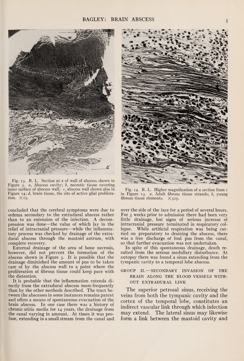 Fig. 13. R. L. Section at x of wall of abscess shown in Figure 3. a, Abscess cavity; b, necrotic tissue covering inner surface of abscess wall; c, abscess wall shown also in Figure 14; d, brain tissue, the site of active glial prolifera¬ tion. Xi5- concluded that the cerebral symptoms were due to oedema secondary to the extradural abscess rather than to an extension of the infection. A decom¬ pression was done—the value of which lay in the relief of intracranial pressure—while the inflamma¬ tory process was checked by drainage of the extra¬ dural abscess through the mastoid antrum, with complete recovery. External drainage of the area of bone necrosis, however, did not prevent the formation of the abscess shown in Figure 3. It is possible that the drainage diminished the amount of pus to be taken care of by the abscess wall to a point where the proliferation of fibrous tissue could keep pace with the distention. It is probable that the inflammation extends di¬ rectly from the extradural abscess more frequently than by the other methods described. The tract be¬ tween the abscesses in some instances remains patent and offers a means of spontaneous evacuation of the brain abscess. In one case there was a history of chronic otitis media for 14 years, the drainage from the canal varying in amount. At times it was pro¬ fuse, extending in a small stream from the canal and Fig. 14. R. L. Higher magnification of a section from c in Figure 13. a, Adult fibrous tissue strands; b, young fibrous tissue elements. X325. over the side of the face for a period of several hours. For 3 weeks prior to admission there had been very little drainage, but signs of serious increase of intracranial pressure terminated in respiratory col¬ lapse. While artificial respiration was being car¬ ried on preparatory to draining the abscess, there was a free discharge of foul pus from the canal, so that further evacuation was not undertaken. In spite of this spontaneous drainage, death re¬ sulted from the serious medullary disturbance. At autopsy there was found a sinus extending from the tympanic cavity to a temporal lobe abscess. GROUP II.—SECONDARY INVASION OF THE BRAIN ALONG THE BLOOD VESSELS WITH¬ OUT EXTRADURAL LINK The superior petrosal sinus, receiving the veins from both the tympanic cavity and the cortex of the temporal lobe, constitutes an indirect vascular link through which infection may extend. The lateral sinus may likewise form a link between the mastoid cavity and