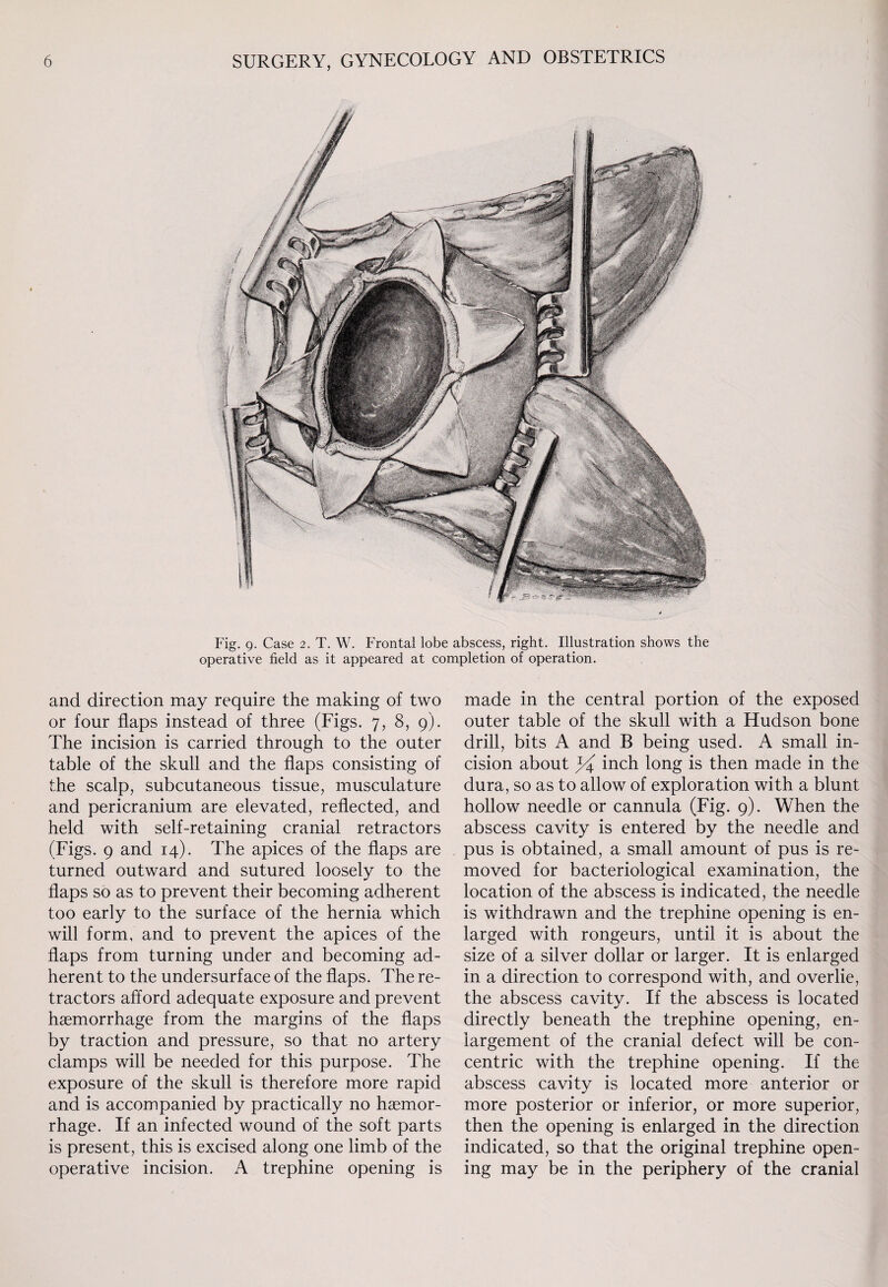 Fig. 9. Case 2. T. W. Frontal lobe abscess, right. Illustration shows the operative field as it appeared at completion of operation. and direction may require the making of two or four flaps instead of three (Figs. 7, 8, 9). The incision is carried through to the outer table of the skull and the flaps consisting of the scalp, subcutaneous tissue, musculature and pericranium are elevated, reflected, and held with self-retaining cranial retractors (Figs. 9 and 14). The apices of the flaps are turned outward and sutured loosely to the flaps so as to prevent their becoming adherent too early to the surface of the hernia which will form, and to prevent the apices of the flaps from turning under and becoming ad¬ herent to the undersurface of the flaps. The re¬ tractors afford adequate exposure and prevent haemorrhage from the margins of the flaps by traction and pressure, so that no artery clamps will be needed for this purpose. The exposure of the skull is therefore more rapid and is accompanied by practically no haemor¬ rhage. If an infected wound of the soft parts is present, this is excised along one limb of the operative incision. A trephine opening is made in the central portion of the exposed outer table of the skull with a Hudson bone drill, bits A and B being used. A small in¬ cision about % inch long is then made in the dura, so as to allow of exploration with a blunt hollow needle or cannula (Fig. 9). When the abscess cavity is entered by the needle and pus is obtained, a small amount of pus is re¬ moved for bacteriological examination, the location of the abscess is indicated, the needle is withdrawn and the trephine opening is en¬ larged with rongeurs, until it is about the size of a silver dollar or larger. It is enlarged in a direction to correspond with, and overlie, the abscess cavity. If the abscess is located directly beneath the trephine opening, en¬ largement of the cranial defect will be con¬ centric with the trephine opening. If the abscess cavity is located more anterior or more posterior or inferior, or more superior, then the opening is enlarged in the direction indicated, so that the original trephine open¬ ing may be in the periphery of the cranial