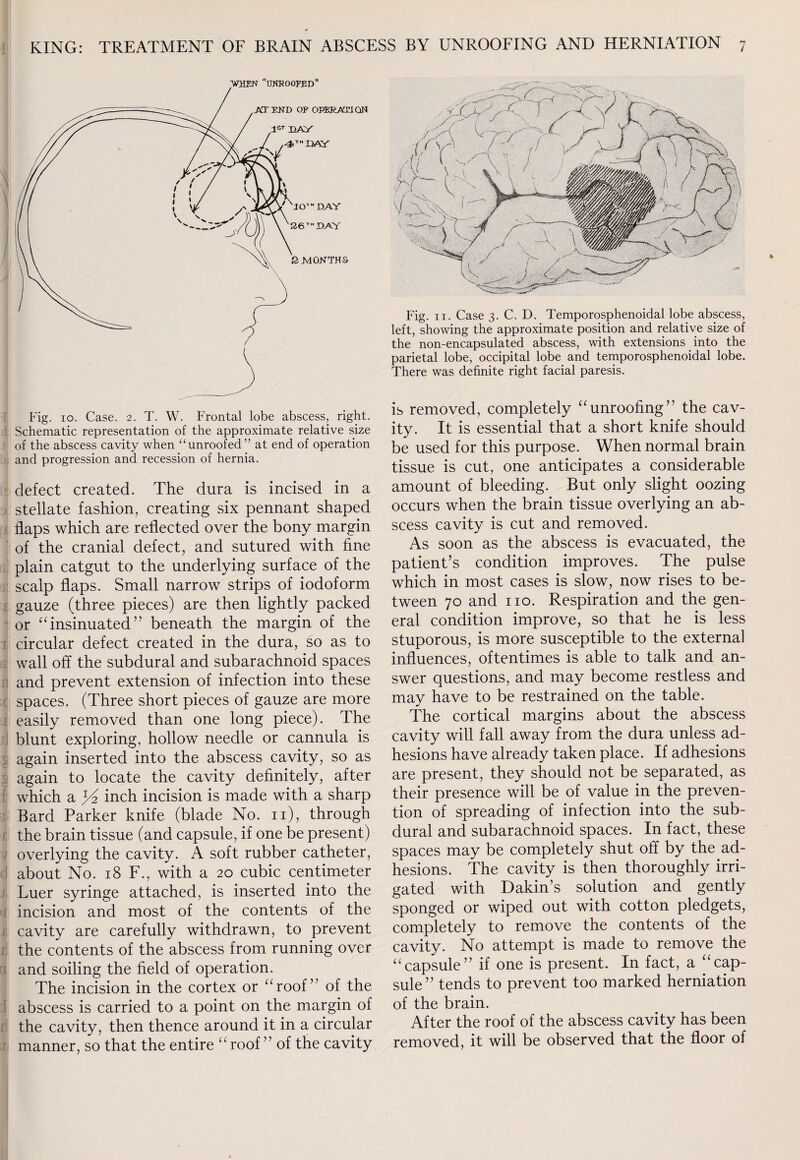 Fig. 10. Case. 2. T. W. Frontal lobe abscess, right. Schematic representation of the approximate relative size of the abscess cavity when “unroofed” at end of operation and progression and recession of hernia. defect created. The dura is incised in a stellate fashion, creating six pennant shaped flaps which are reflected over the bony margin of the cranial defect, and sutured with fine plain catgut to the underlying surface of the scalp flaps. Small narrow strips of iodoform gauze (three pieces) are then lightly packed or “insinuated” beneath the margin of the circular defect created in the dura, so as to wall off the subdural and subarachnoid spaces and prevent extension of infection into these spaces. (Three short pieces of gauze are more easily removed than one long piece). The blunt exploring, hollow needle or cannula is again inserted into the abscess cavity, so as again to locate the cavity definitely, after which a inch incision is made with a sharp Bard Parker knife (blade No. n), through the brain tissue (and capsule, if one be present) overlying the cavity. A soft rubber catheter, about No. 18 F., with a 20 cubic centimeter Luer syringe attached, is inserted into the incision and most of the contents of the cavity are carefully withdrawn, to prevent the contents of the abscess from running over and soiling the field of operation. The incision in the cortex or “roof” of the abscess is carried to a point on the margin of the cavity, then thence around it in a circular manner, so that the entire “ roof ” of the cavity Fig. 11. Case 3. C. D. Temporosphenoidal lobe abscess, left, showing the approximate position and relative size of the non-encapsulated abscess, with extensions into the parietal lobe, occipital lobe and temporosphenoidal lobe. There was definite right facial paresis. is removed, completely “unroofing” the cav¬ ity. It is essential that a short knife should be used for this purpose. When normal brain tissue is cut, one anticipates a considerable amount of bleeding. But only slight oozing occurs when the brain tissue overlying an ab¬ scess cavity is cut and removed. As soon as the abscess is evacuated, the patient’s condition improves. The pulse which in most cases is slow, now rises to be¬ tween 70 and no. Respiration and the gen¬ eral condition improve, so that he is less stuporous, is more susceptible to the external influences, oftentimes is able to talk and an¬ swer questions, and may become restless and may have to be restrained on the table. The cortical margins about the abscess cavity will fall away from the dura unless ad¬ hesions have already taken place. If adhesions are present, they should not be separated, as their presence will be of value in the preven¬ tion of spreading of infection into the sub¬ dural and subarachnoid spaces. In fact, these spaces may be completely shut off by the ad¬ hesions. The cavity is then thoroughly irri¬ gated with Dakin’s solution and gently sponged or wiped out with cotton pledgets, completely to remove the contents of the cavity. No attempt is made to remove the “capsule” if one is present. In fact, a “cap¬ sule” tends to prevent too marked herniation of the brain. After the roof of the abscess cavity has been removed, it will be observed that the floor of