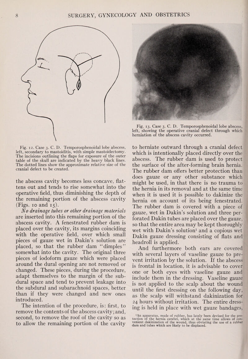 Fig. 12. Case 3. C. D. Temporosphenoidal lobe abscess, left, secondary to mastoiditis, with simple mastoidectomy. The incisions outlining the flaps for exposure of the outer table of the skull are indicated by the heavy black lines. The dotted lines show the approximate relative size of the cranial defect to be created. the abscess cavity becomes less concave, flat¬ tens out and tends to rise somewhat into the operative field, thus diminishing the depth of the remaining portion of the abscess cavity (Figs. 10 and 15). No drainage tubes or other drainage materials are inserted into this remaining portion of the abscess cavity. A fenestrated rubber dam is placed over the cavity, its margins coinciding with the operative field, over which small pieces of gauze wet in Dakin’s solution are placed, so that the rubber dam “dimples” somewhat into the cavity. The original three pieces of iodoform gauze which were placed around the dural opening are not removed or changed. These pieces, during the procedure, adapt themselves to the margin of the sub¬ dural space and tend to prevent leakage into the subdural and subarachnoid spaces, better than if they were changed and new ones introduced. The intention of the procedure, is: first, to remove the contents of the abscess cavity; and, second, to remove the roof of the cavity so as to allow the remaining portion of the cavity Fig. 13. Case 3. C. D. Temporosphenoidal lobe abscess, left, showing the operative cranial defect through which herniation of the abscess cavity occurred. to herniate outward through a cranial defect which is intentionally placed directly over the abscess. The rubber dam is used to protect the surface of the after-forming brain hernia. The rubber dam offers better protection than does gauze or any other substance which might be used, in that there is no trauma to the hernia in its removal and at the same time when it is used it is possible to dakinize the hernia on account of its being fenestrated. The rubber dam is covered with a piece of gauze, wet in Dakin’s solution and three per¬ forated Dakin tubes are placed over the gauze, so that the entire area may be kept thoroughly wet with Dakin’s solution1 and a copious wet Dakin gauze dressing consisting of flats and headroll is applied. And furthermore both ears are covered with several layers of vaseline gauze to pre¬ vent irritation by the solution. If the abscess is frontal in location, it is advisable to cover one or both eyes with vaseline gauze and include them in the dressing. Vaseline gauze is not applied to the scalp about the wound until the first dressing on the following day, as the scalp will withstand dakinization for 24 hours without irritation. The entire dress¬ ing is held in place with wet gauze bandages, !An apparatus, made of rubber, has lately been devised for the pro¬ tection of the hernia cerebri, which at the same time allows of con¬ venient dakinization of the wound, thus obviating the use of a rubber dam and tubes which are likely to be displaced.