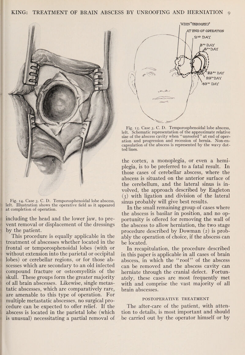 Fig. 14. Case 3. C. D. Temporosphenoidal lobe abscess, left. Illustration shows the operative field as it appeared at completion of operation. including the head and the lower jaw, to pre¬ vent removal or displacement of the dressings by the patient. This procedure is equally applicable in the treatment of abscesses whether located in the frontal or temporosphenoidal lobes (with or without extension into the parietal or occipital lobes) or cerebellar regions, or for those ab¬ scesses which are secondary to an old infected compound fracture or osteomyelitis of the skull. These groups form the greater majority of all brain abscesses. Likewise, single metas¬ tatic abscesses, which are comparatively rare, are amenable to this type of operation. For multiple metastatic abscesses, no surgical pro¬ cedure can be expected to offer relief. If the abscess is located in the parietal lobe (which is unusual) necessitating a partial removal of Fig. 15. Case 3. C. D. Temporosphenoidal lobe abscess, left. Schematic representation of the approximate relative size of the abscess cavity when “unroofed” at end of oper¬ ation and progression and recession of hernia. Non-en¬ capsulation of the abscess is represented by the wavy dot¬ ted lines. the cortex, a monoplegia, or even a hemi¬ plegia, is to be preferred to a fatal result. In those cases of cerebellar abscess, where the abscess is situated on the anterior surface of the cerebellum, and the lateral sinus is in¬ volved, the approach described by Eagleton (3) with ligation and division of the lateral sinus probably will give best results. In the small remaining group of cases where the abscess is basilar in position, and no op¬ portunity is offered for removing the wall of the abscess to allow herniation, the two stage procedure described by Dowman (2) is prob¬ ably the operation of choice, if the abscess can be located. In recapitulation, the procedure described in this paper is applicable in all cases of brain abscess, in which the “roof” of the abscess can be removed and the abscess cavity can herniate through the cranial defect. Fortun¬ ately, these cases are most frequently met with and comprise the vast majority of all brain abscesses. POSTOPERATIVE TREATMENT The after-care of the patient, with atten¬ tion to details, is most important and should be carried out by the operator himself or by