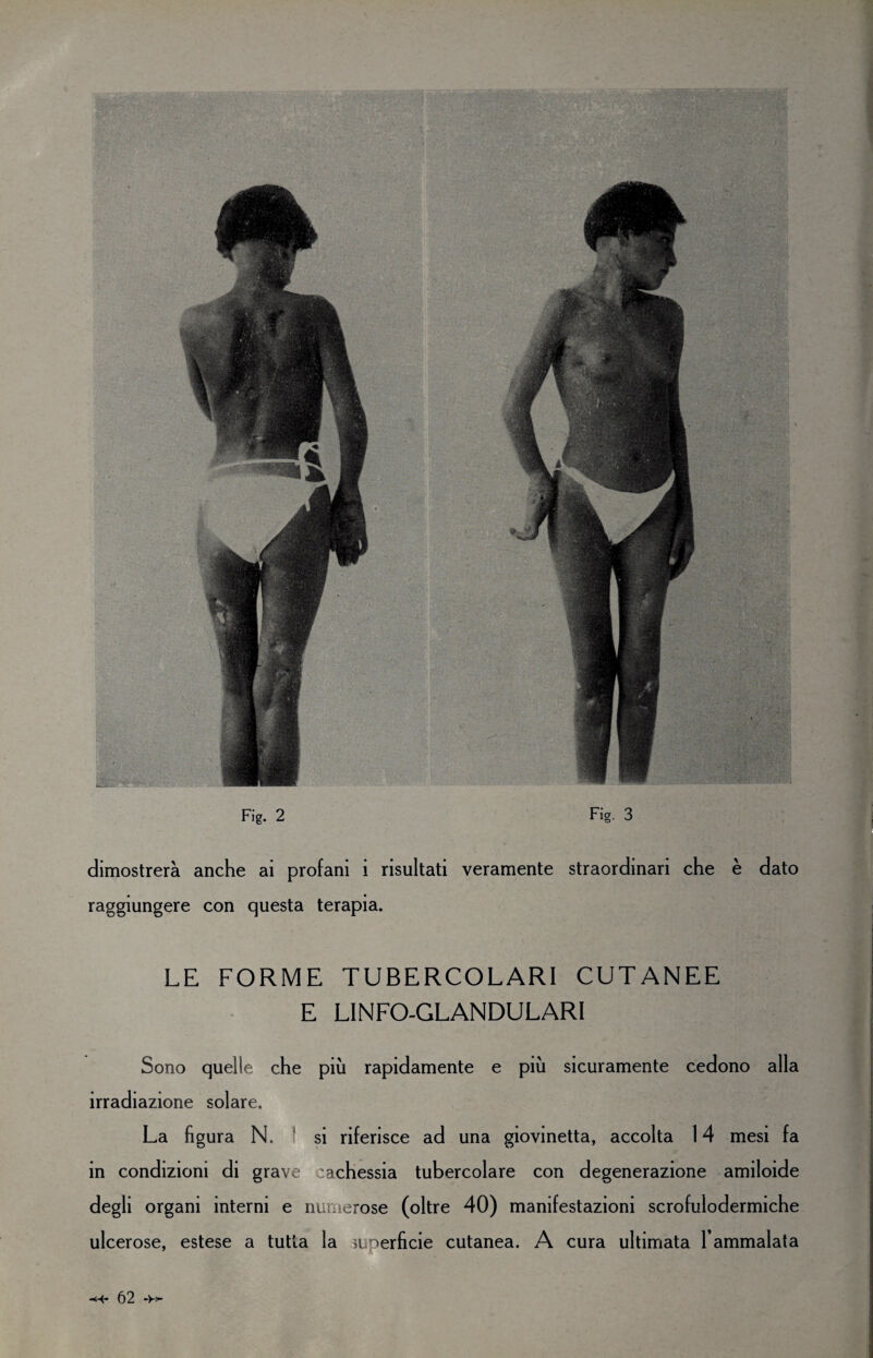 Fi* 2 dimostrerà anche ai profani i risultati veramente straordinari che è dato raggiungere con questa terapia. LE FORME TUBERCOLARI CUTANEE E LINFO-GLANDULARI Sono quelle che più rapidamente e più sicuramente cedono alla irradiazione solare. La figura N. si riferisce ad una giovinetta, accolta 14 mesi fa in condizioni di grave cachessia tubercolare con degenerazione amiloide degli organi interni e numerose (oltre 40) manifestazioni scrofulodermiche ulcerose, estese a tutta la superficie cutanea. A cura ultimata l’ammalata