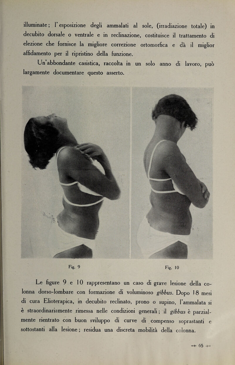 illuminate ; 1 esposizione degli ammalati al sole, (irradiazione totale) in decubito dorsale o ventrale e in reclinazione, costituisce il trattamento di elezione che fornisce la migliore correzione ortomorfìca e dà il miglior affidamento per il ripristino della funzione. Un abbondante casistica, raccolta in un solo anno di lavoro, può largamente documentare questo asserto. 9 Fig. IO Le figure 9 e 10 rappresentano un caso di grave lesione della co¬ lonna dorso-lombare con formazione di voluminoso gibbus. Dopo 18 mesi di cura Elioterapica, in decubito reclinato, prono o supino, l’ammalata si è straordinariamente rimessa nelle condizioni generali ; il gibbus è parzial¬ mente rientrato con buon sviluppo di curve di compenso soprastanti e sottostanti alla lesione ; residua una discreta mobilità della colonna.