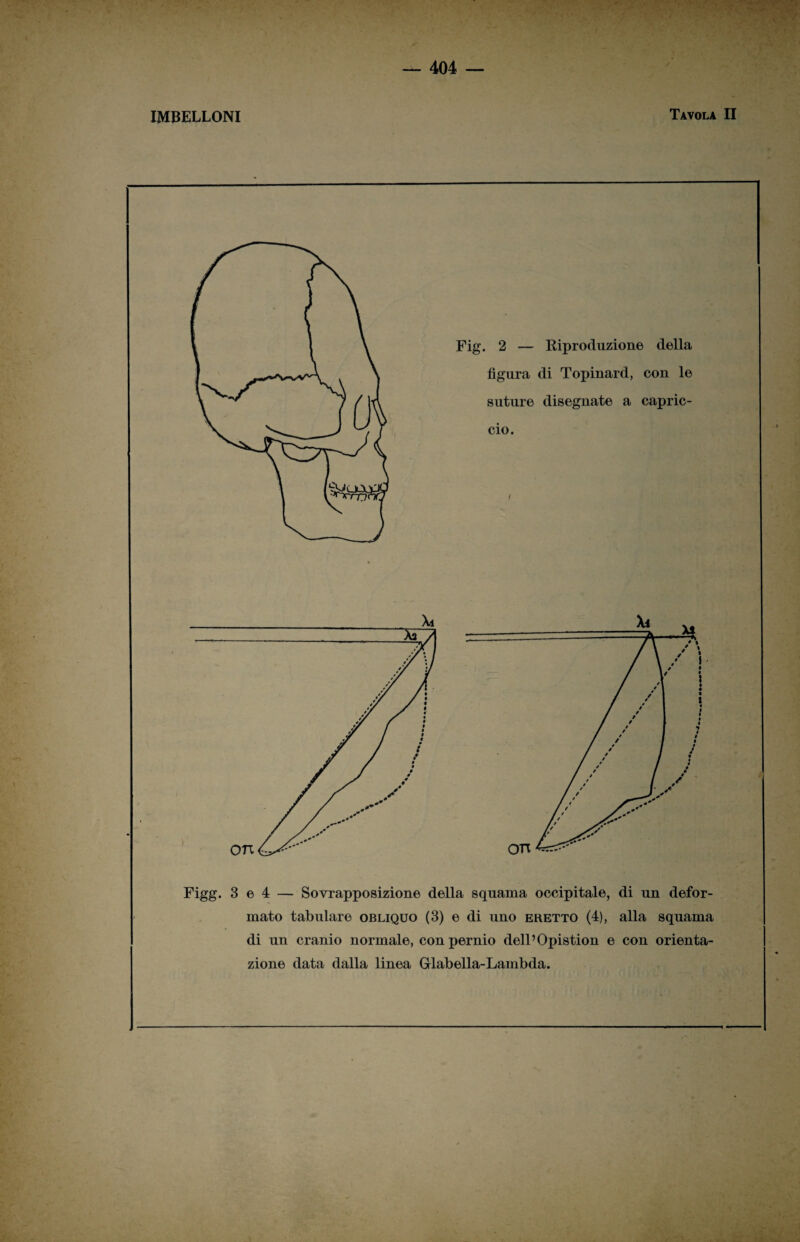 IMBELLONI Tavola II Fig. 2 — Riproduzione della figura di Topinard, con le suture disegnate a capric¬ cio. i Figg. 3 e 4 — Sovrapposizione della squama occipitale, di un defor¬ mato tabulare obliquo (3) e di uno eretto (4), alla squama di un cranio normale, con pernio dell’Opistion e con orienta¬ zione data dalla linea Griabella-Lambda.