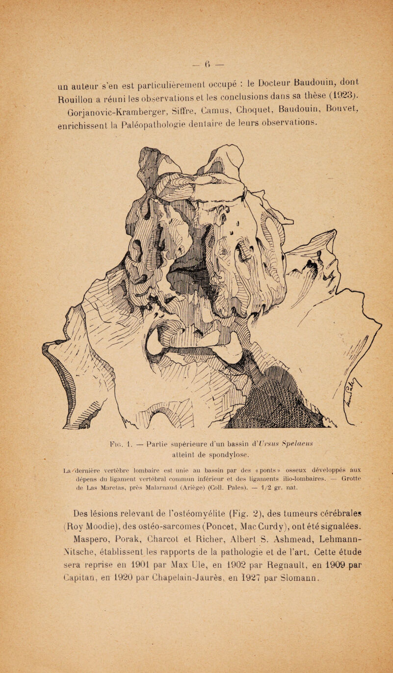 un auteur sen est particulierement occupe : le Docteur Baudouin, dont Rouillon a reuni les observations et les conclusions dans sa these (1923y Gorjanovic-Kramberger, Siffre, Camus, Choquet, Baudouin, Bouvet, enrichissent la Paleopathologie dentaire de leurs observations. Fig. 1. — Partie superieure d'un bassin d'Ursus Spelaeus atteint de spondylose. La/demiere vertebre lombaire est unie au bassin par ties «ponts» osseux developpes aux depens du ligament vertebral eotnmun inferieur et des ligaments ilio-lombaires. — Grotte de Las Maretas, pres Malarnaud (Ariege) (Coll. Pales). — 'I/2 gr. nat. Des lesions relevant de l’osteomyelite (Fig. 2), des tumeurs cerebrates (Roy Moodie), des osteo-sarcomes (Poncet, Mac Curdy), ontetesignalees. Maspero, Porak, Charcot et Richer, Albert S. Ashmead, Lehmann- Nitsche, etablissent les rapports de la pathologie et de l’art. Cette etude sera reprise en 1901 par Max Ule, en 1902 par Regnault, en 1909 par