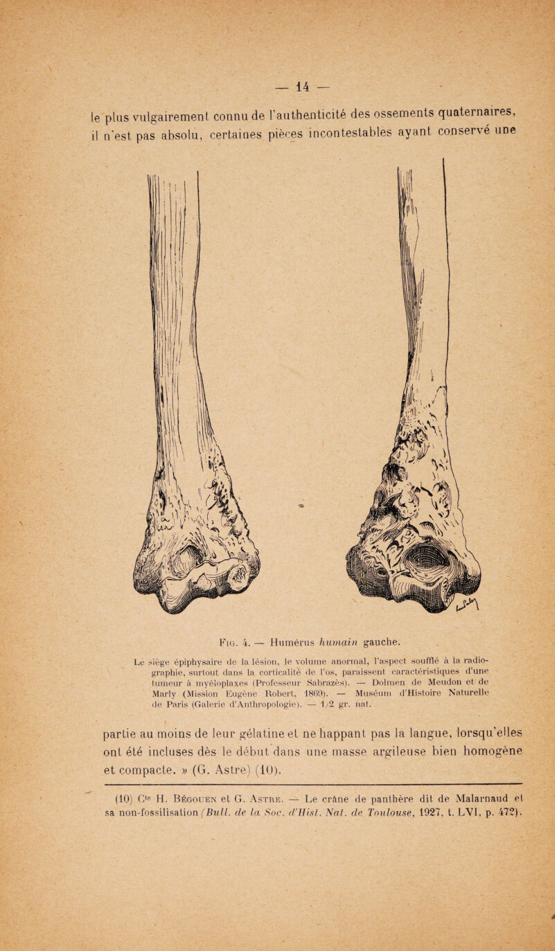 le plus vulgairement connu de 1’authenticity des ossements quaternaires, il n'est pas absolu, certaiues pieces incontestables ay ant conserve une Fig. 4. — Humerus humain gauche. Le siege epiphysaire de la lesion, le volume anormal, l'aspect souffle a la radio- graphie, surtout dans la corticalite de l’os, paraissent caracteristiques d’une tumeur a myeloplaxes (Professeur Sabrazes). — Dolmen de Meudon et de Marly (Mission Eugene Robert, 1869). — Museum d’Histoire Naturelle de Paris (Galerie d’Anthropologie). — 1/2 gr. nat. partie au moins de leur gelatine et nehappant pas la langue, lorsqu’elles out ete incluses des le debut dans une masse argileuse bien homogene et compacte. » (G. Astre) (10). (10) Gte H. B6gouen et G. Astre. — Le cr&ne de panthere dit de Malarnaud et sa non-fossilisation (Bull, de la $oc. d’Hist. Nat. de Toulouse, 1927, t. LVI, p. 472).