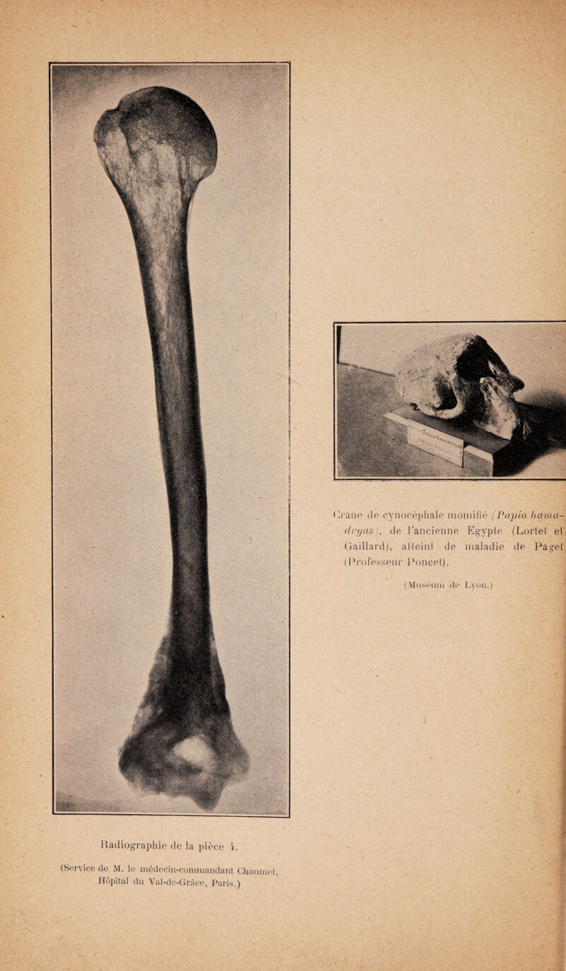 (Service de M. le medecin-commandanl Chaumol, Hopital du Val-de-Grace, Paris.) Crane de cynofcephale momifie (Papio hama¬ dryad), de Rancienne Egypte (Lortet et Gaillard), atteint de maladie de Pagel (Professenr Poncet). (Museum de Lyon.)