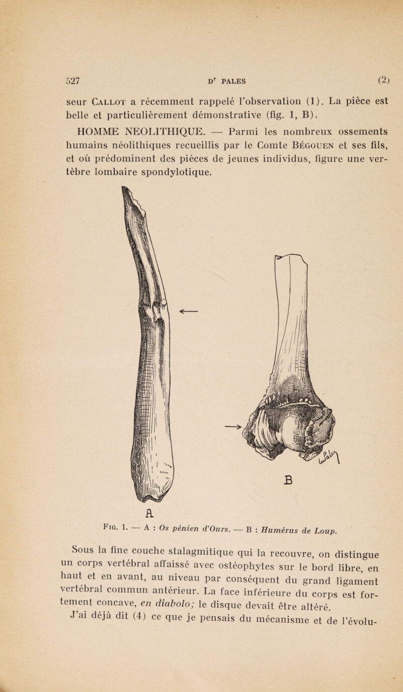 seur Callot a recemment rappele fobservation (1). La piece est belle et particulierement demonstrative (fig. 1, B). HOMME NEOLITHIQUE. — Parmi les nombreux ossements humains neolithiques recueillis par le Comte Begouen et ses tils, et oil predominent des pieces de jeunes individus, figure une ver- tebre lombaire spondylotique. A Fig. 1. — A : Os penien d’Ours. — B : Humerus de Loup. Sous la tine couche stalagmitique qui la recouvre, on distingue un corps vertebral affaisse avec osteophytes sur le bord libre, en haut et en avant, au niveau par consequent du grand ligament vertebral commun anterieur. La face inferieure du corps est for- tement concave, en diaholo; le disque devait etre altere. J ai deja dit (4) ce que je pensais du mecanisme et de 1’evolu-