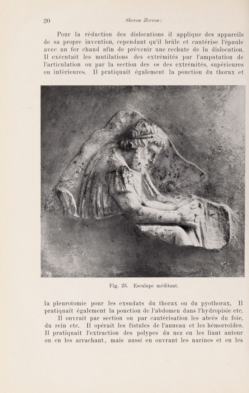 Pour la reduction des dislocations il applique des appareils de sa propre invention, cependant qiPil brule et cauterise Pepaule avec un ter chaud afin de preveuir une recliute de la dislocation. 11 executait les mutilations des extremites par Pamputation de Particulation on par la section des os des extremites, superieures on inferieures. II pratiquait egalement la ponction du thorax et Fig. 23. Esculape meditant. la pleurotomie pour les exsudats du thorax on du pyothorax. II pratiquait egalement la ponction de Pabdomen dans Phydropisie etc. II ouvrait par section on par cauterisation les abces du foie, du rein etc. II operait les fistules de Panneau et les hemorroides. 11 pratiquait Pextraction des polypes du nez en les liant autour ou en les arrachant, mais aussi en ouvrant les narines et en les