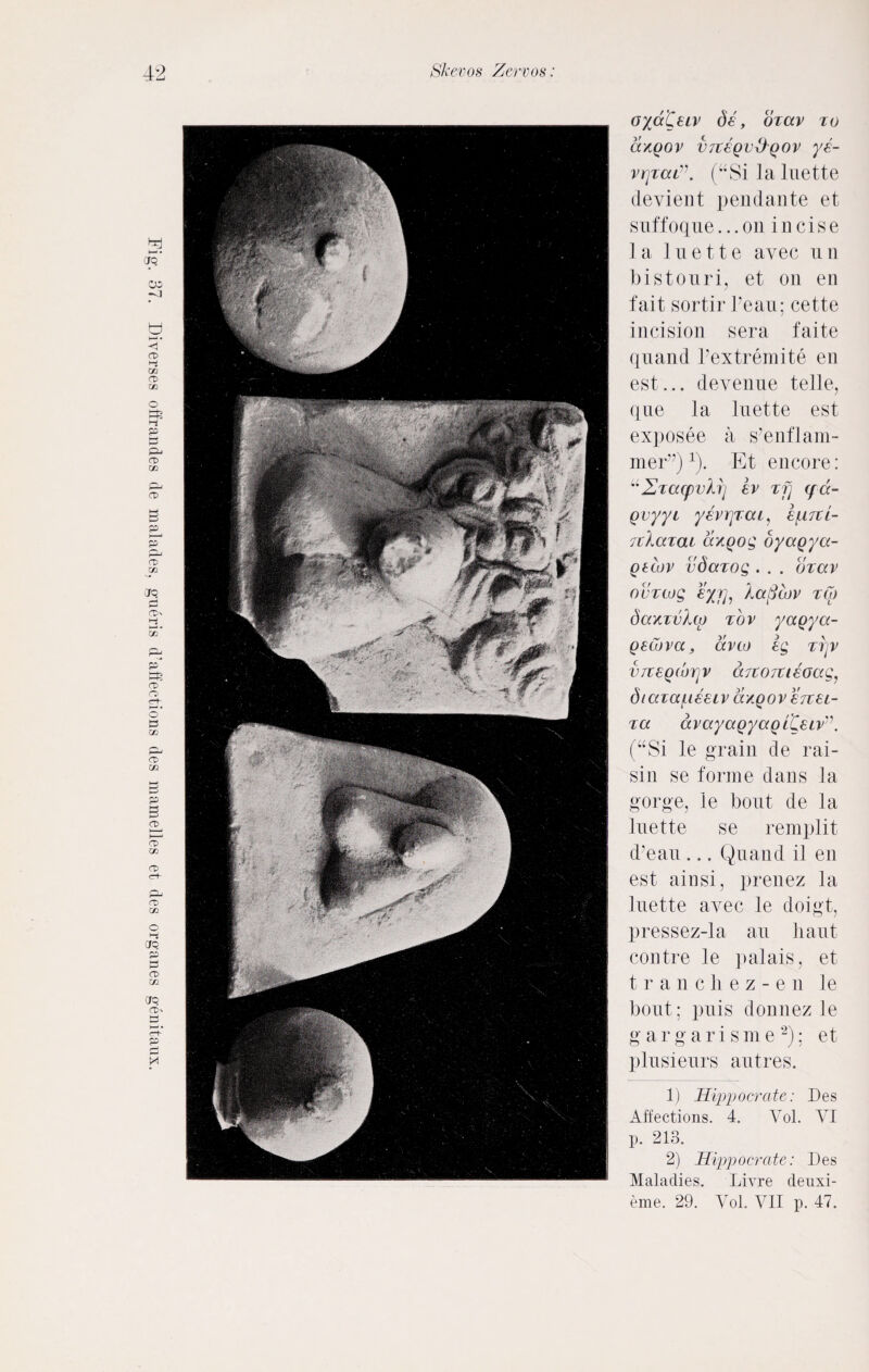 Fig. 37. Diverges offrandes de malades, gneris d’affections des raamelles et des organes genitaux. oyd'Ceiv de, ozav zo dxgov vrtegvllgov ye- vrjzca(“Silaluette devient pendante et suffoque...on incise 1 a 1 u e 11 e avec u n bistouri, et on en fait sortir Feau; cette incision sera faite quand Fextremite en est... devenue telle, que la Inette est exposee a s’enf Jam¬ mer”) 1). Fit encore: u Zzacpvkrj ev zfj (pd- gvyyi yerrjzai, e/UTtl- rcXazat dxgog oyagya- gtcov vdazog . . . dzav ovzcug eyrj, la (Slav zw daxzvXtp zov yagya- getiva, dvto eg zijv V7teg(brjv drcojtieoag, diaza/ueeiv dxgovenet- za dvayagyagl^eiv (“Si le grain de rai¬ sin se forme dans la gorge, le bout de la Inette se remplit d’eau ... Quand il en est ainsi, prenez la luet-te avec le doigt, pressez-la an haut contre le palais, et t r a nchez-en le bout; puis donnez le gargarisme 2); et plusieurs autres. 11 1iipp o crate: Des Affections. 4. Vol. VI p. 213. 2) 1Tippocrate: Des Maladies. Livre denxi- eme. 29. Vol. VII p. 47.