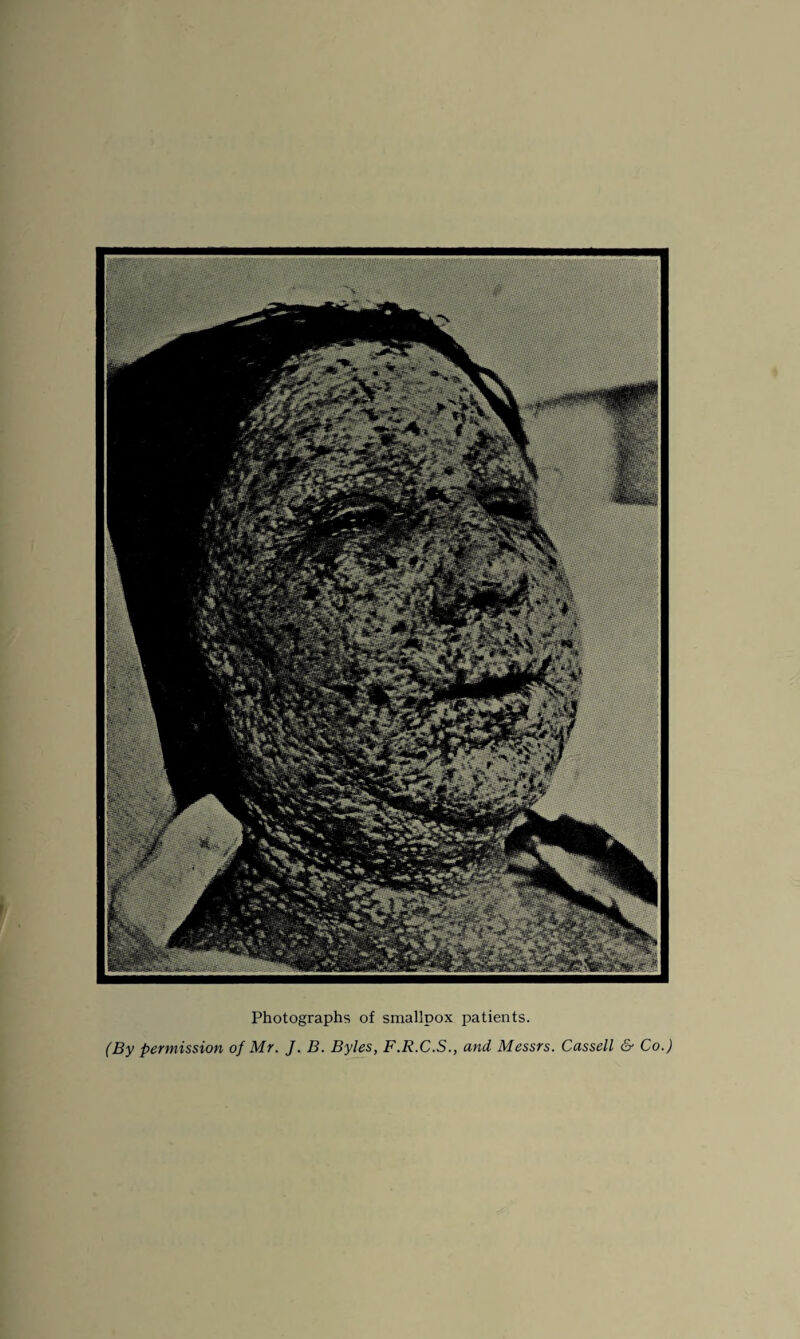 Photographs of smallpox patients.