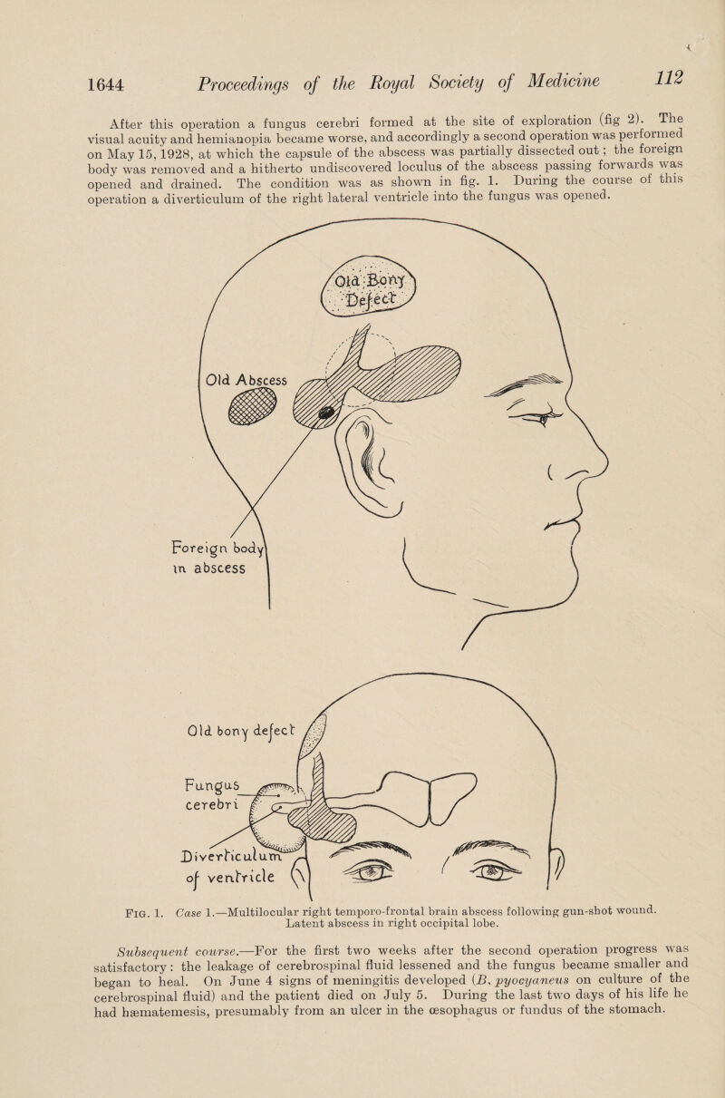 112 After this operation a fungus cerebri formed at the site of exploration (fig 2). The visual acuity and hemianopia became worse, and accordingly a second operation was pei forme on May 15,1928, at which the capsule of the abscess was partially dissected out ; the foreign body was removed and a hitherto undiscovered loculus of the abscess, passing forwards was opened and drained. The condition was as shown in fig. 1. During the couise of this operation a diverticulum of the right lateral ventricle into the fungus was opened. Fig. 1. Case 1.—Multilocular right temporo-frontal brain abscess following gun-shot wound. Latent abscess in right occipital lobe. Subsequent course.—For the first two weeks after the second operation progress was satisfactory: the leakage of cerebrospinal fluid lessened and the fungus became smaller and began to heal. On June 4 signs of meningitis developed (B, pyocyaneus on culture of the cerebrospinal fluid) and the patient died on July 5. During the last two days of his life he had hgematemesis, presumably from an ulcer in the oesophagus or fundus of the stomach.