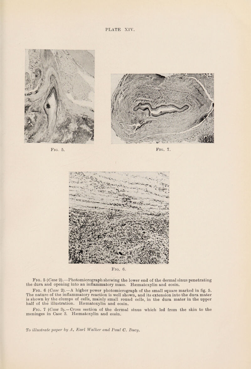PLATE XIV. Fig. 5. Fig. 7. Fig. 6. Fig. 5 (Case 2).—Photomicrograph showing the lower end of the dermal sinus penetrating the dura and opening into an inflammatory mass. Hsematoxylin and eosin. Fig. 6 (Case 2).—A higher power photomicrograph of the small square marked in fig. 5. The nature of the inflammatory reaction is well shown, and its extension into the dura mater is shown by the clumps of cells, mainly small round cells, in the dura mater in the upper half of the illustration. Hsematoxylin and eosin. Fig. 7 (Case 3;.— Cross section of the dermal sinus which led from the skin to the meninges in Case 3. Hsematoxylin and eosin. To illustrate paper by A. Earl Walker and Paul C. Bucy.