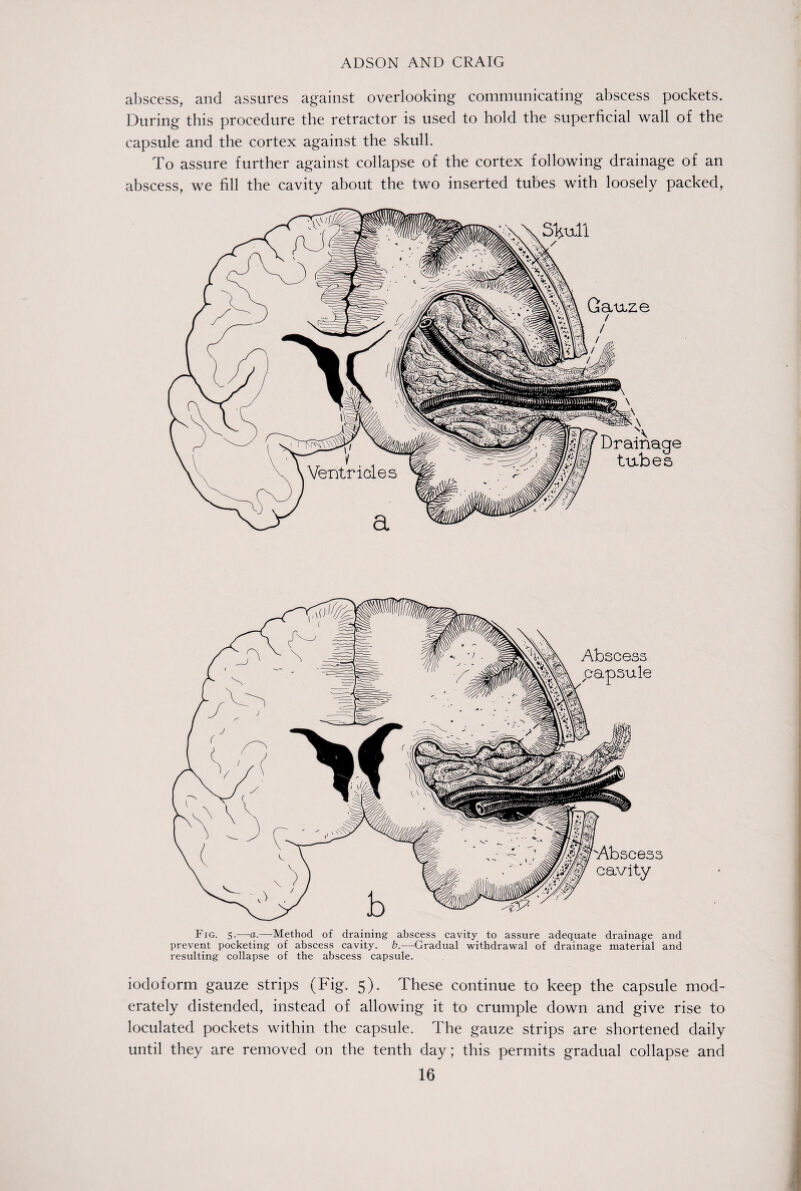 abscess, and assures against overlooking communicating abscess pockets. During this procedure the retractor is used to hold the superficial wall of the capsule and the cortex against the skull. To assure further against collapse of the cortex following drainage of an abscess, we fill the cavity about the two inserted tubes with loosely packed, Fig. 5.—a.—-Method of draining abscess cavity to assure adequate drainage and prevent pocketing of abscess cavity, b.—Gradual withdrawal of drainage material and resulting collapse of the abscess capsule. iodoform gauze strips (Fig. 5). These continue to keep the capsule mod¬ erately distended, instead of allowing it to crumple down and give rise to loculated pockets within the capsule. The gauze strips are shortened daily until they are removed on the tenth day; this permits gradual collapse and