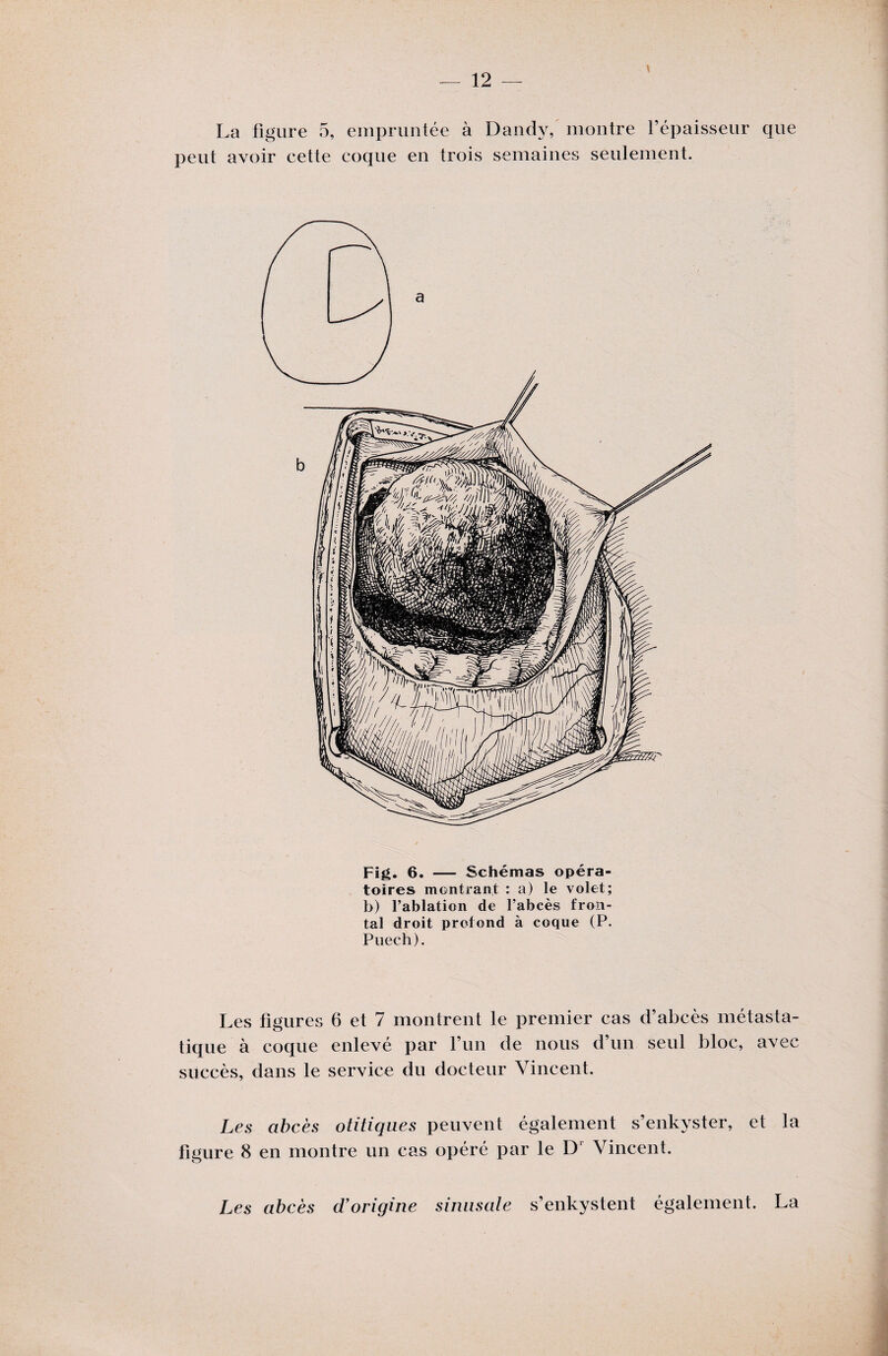 La figure 5, empruntée à Dandy, montre l’épaisseur que peut avoir cette coque en trois semaines seulement. Fig. 6. — Schémas opéra¬ toires montrant : a) le volet; b) l’ablation de l’abcès fron¬ tal droit profond à coque (P. Puech). Les figures 6 et 7 montrent le premier cas d’abcès métasta¬ tique à coque enlevé par l’un de nous d’un seul bloc, avec succès, dans le service du docteur Vincent. Les abcès otitiques peuvent également s’enkyster, et la figure 8 en montre un cas opéré par le D' Vincent. Les abcès d’origine sinusale s’enkystent également. La