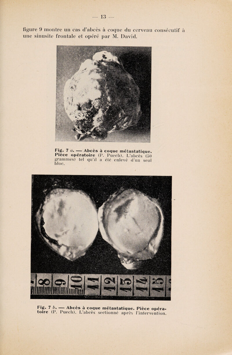 figure 9 montre un cas d’abcès à coque du cerveau consécutif à une sinusite frontale et opéré par M. David. Fig. 7 a. — Abcès à coque métastatique. Pièce opératoire (P. Puech). L’abcès (50 grammes) tel qu’il a été enlevé d’un seul bloc. Fig. 7 b. — Abcès à coque métastatique. Pièce opéra¬ toire (P. Puech). L’abcès sectionné après l’intervention.