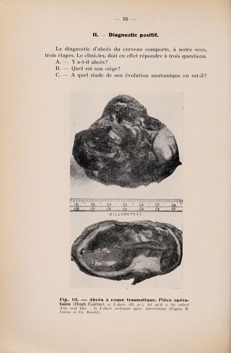 II. — Diagnostic positif. Le diagnostic d’abcès du cerveau comporte, à notre sens, trois étapes. Le clinicien doit en effet répondre à trois questions. A. — Y a-t-il abcès? B. — Quel est son siège? G. — A quel stade de son évolution anatomique en est-il? Fig. 10. — Abcès à coque traumatique. Pièce opéra¬ toire (Hugh Cairns). a) L’abcès (85 gr.), tel qu’il a été enlevé d’un seul bloc ; b) L’abcès sectionné après intervention (d'après IL Cairns et Ch. Donald).