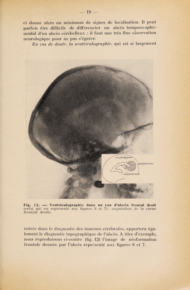 et donne alors un minimum de signes de localisation. Il peut parfois être difficile de différencier un abcès temporo-sphé- noidal d’un abcès cérébelleux : il faut une très fine observation neurologique pour ne pas s’égarer. En cas de doute, la ventriculographie, qui est si largement r Fig. 12. — Ventriculographie dans on cas d’abcès frontal droit (celai qui est représenté aux figures 6 et 7) : amputation de la corne frontale droite. entrée dans le diagnostic des tumeurs cérébrales, apportera éga¬ lement le diagnostic topographique de l’abcès. A titre d’exemple, nous reproduisons ci-contre (fîg. 12) l’image de néoformation frontale donnée par l’abcès représenté aux figures 6 et 7.