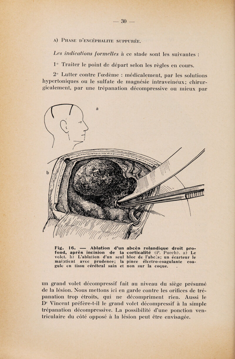 a) Phase d’encéphalite suppurée. Les indications formelles à ce stade sont les suivantes : 1° Traiter le point de départ selon les règles en cours. 2° Lutter contre l’œdème : médicalement, par les solutions hypertoniques ou le sulfate de magnésie intraveineux; chirur¬ gicalement, par une trépanation décompressive ou mieux par Fig. 16. — Ablation d’un abcès rolandique droit pro¬ fond, après incision de la corticalité (P. Puech). a) Le volet, b) L’ablation d’un seul bloc de l’abcès; un écarteur le maintient avec prudence; la pince électro-coagulante coa¬ gule en tissu cérébral sain et non sur la coque. un grand volet décompressif fait au niveau du siège présumé de la lésion. Nous mettons ici en garde contre les orifices de tré¬ panation trop étroits, qui ne décompriment rien. Aussi le Dr Vincent préfère-t-il le grand volet décompressif à la simple trépanation décompressive. La possibilité d’une ponction ven¬ triculaire du côté opposé à la lésion peut être envisagée.